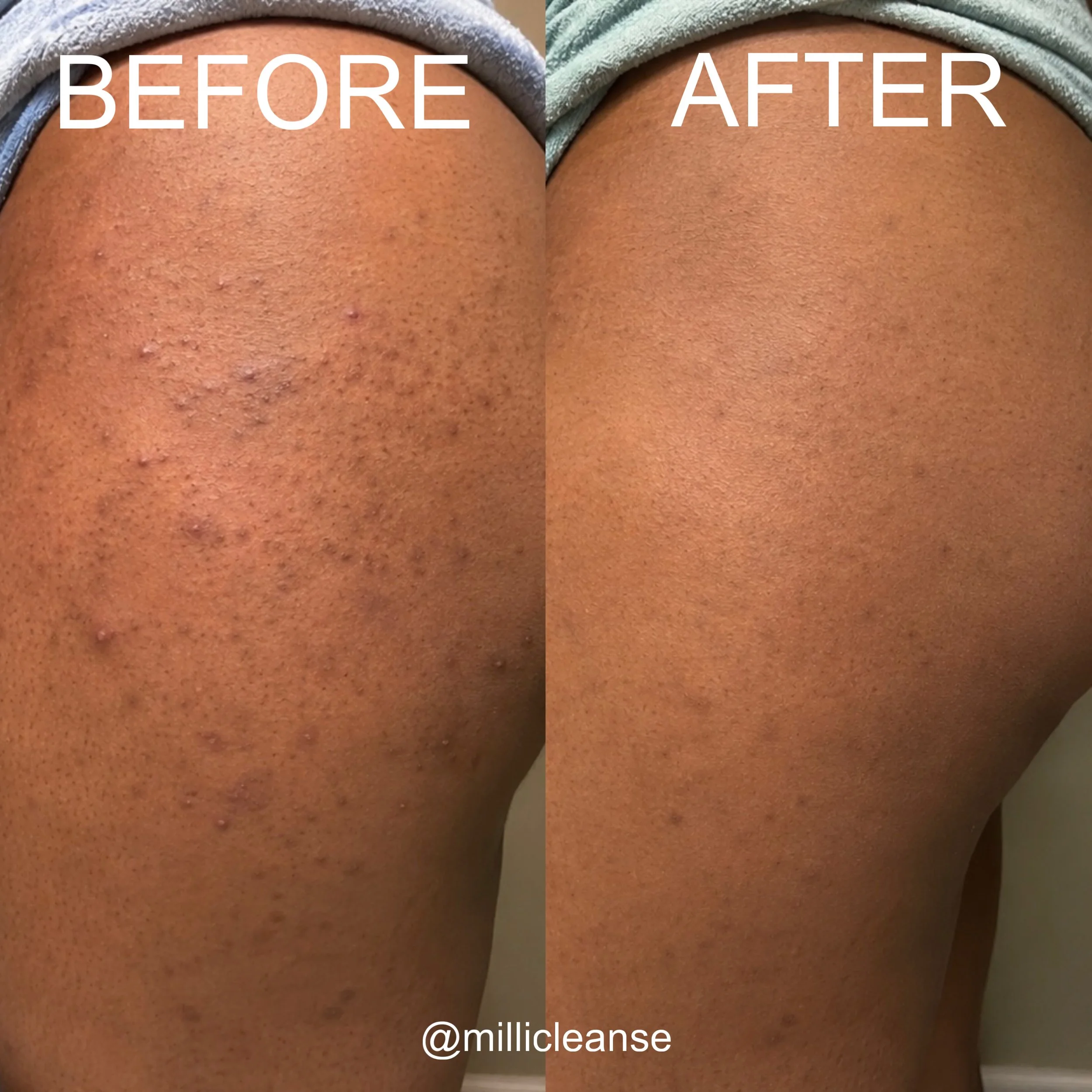 Before and after comparison of butt acne showing changes in the appearance of blemishes and skin texture.