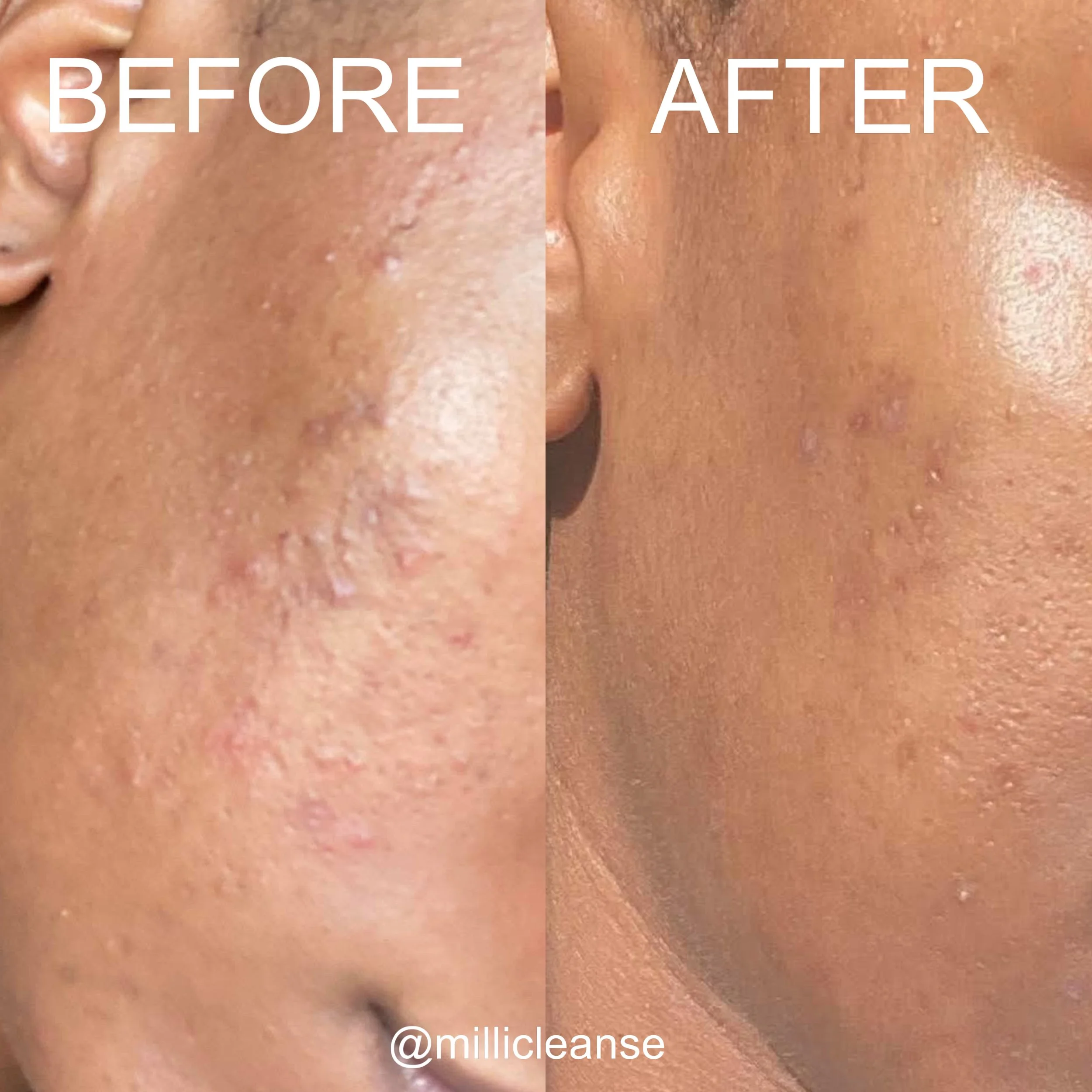Before and after acne comparison showing changes in visible blemishes and skin texture.