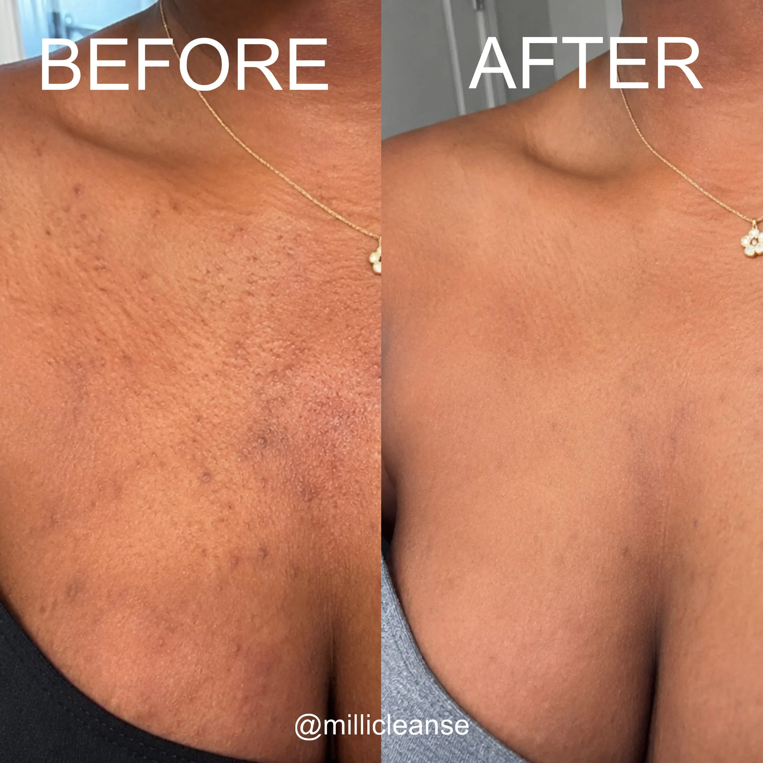Before and after chest acne comparison showing changes in the appearance of blemishes and skin texture.