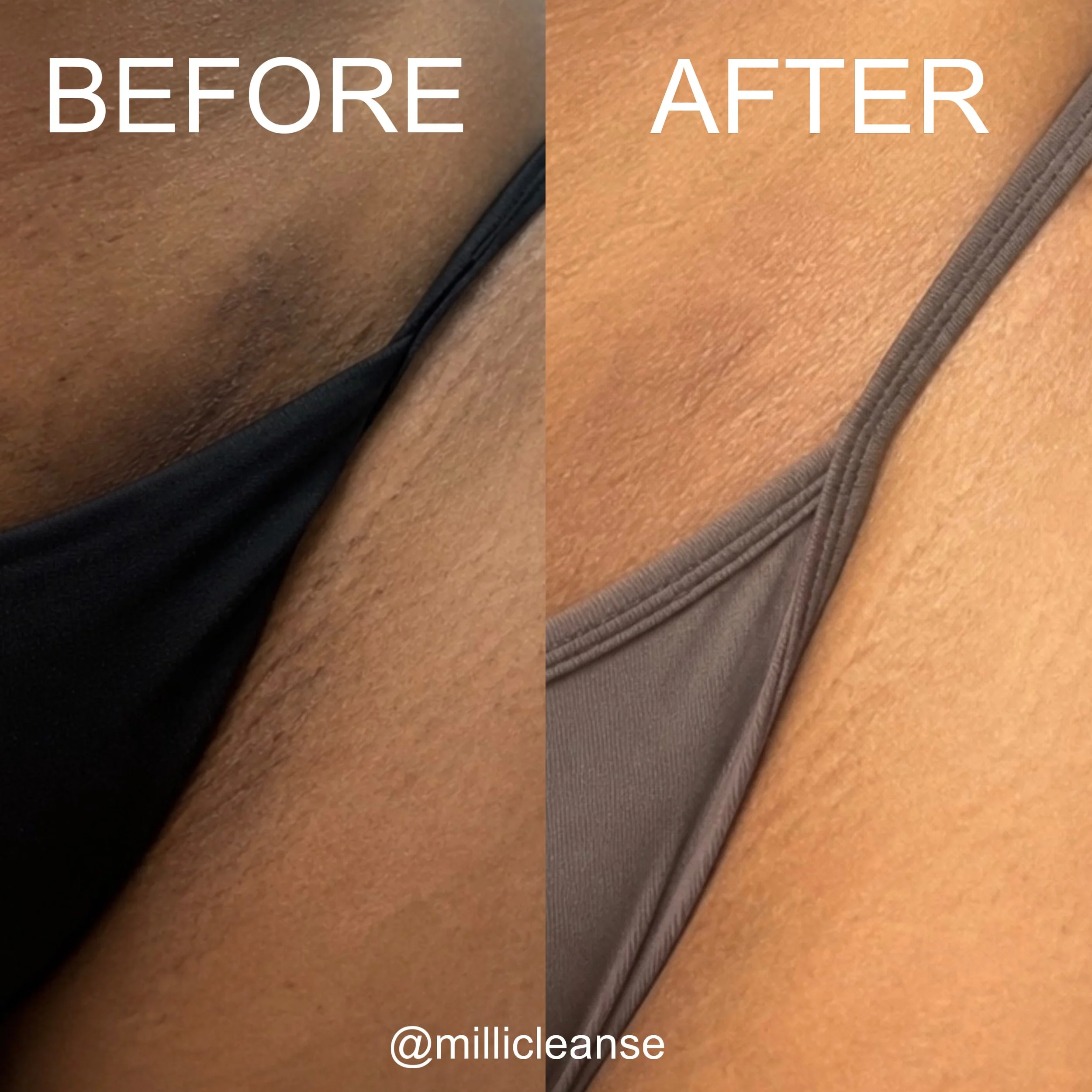 Before and after bikini line hyperpigmentation comparison showing changes in dark spots and uneven skin tone.