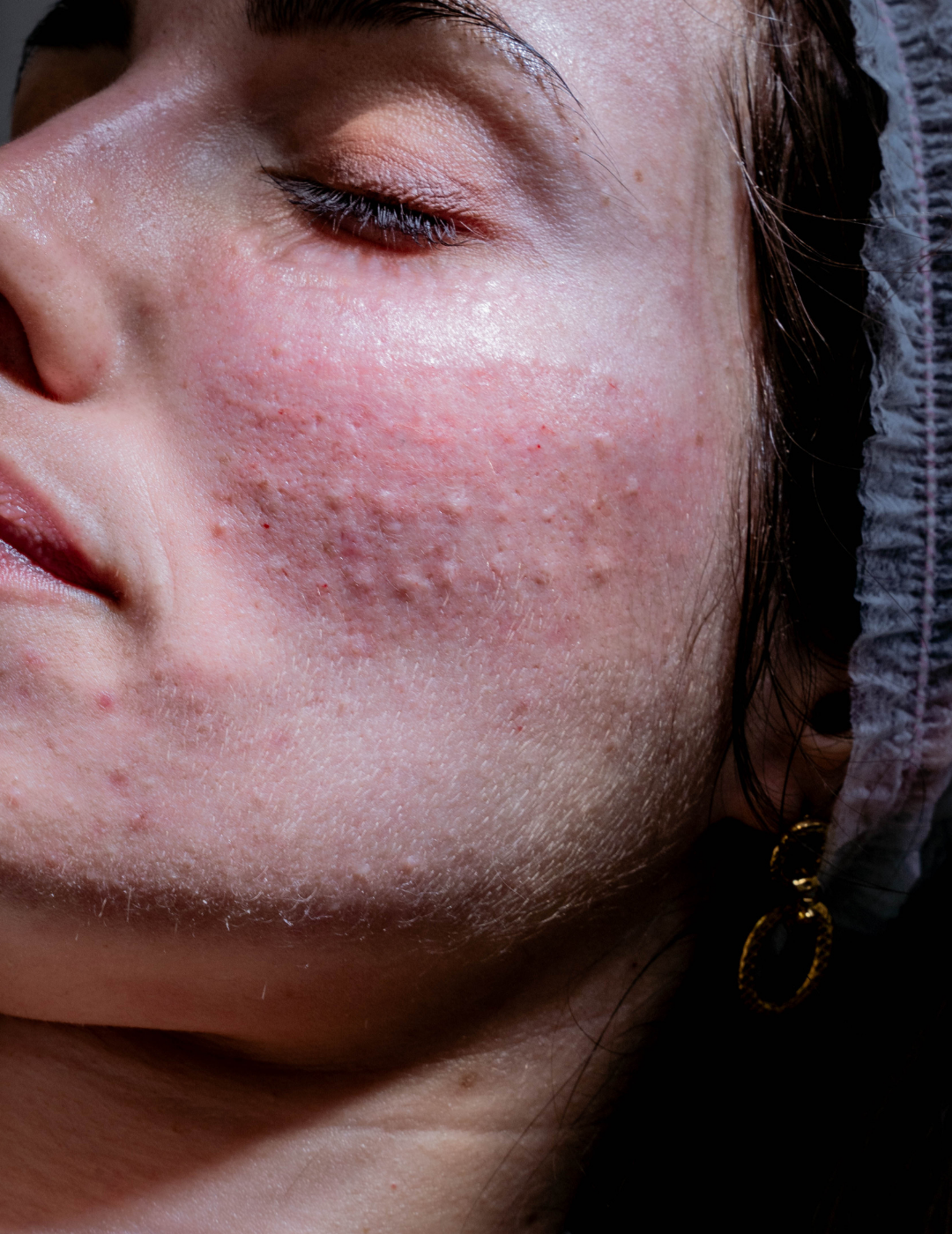 Mesoterapia_Facial.png