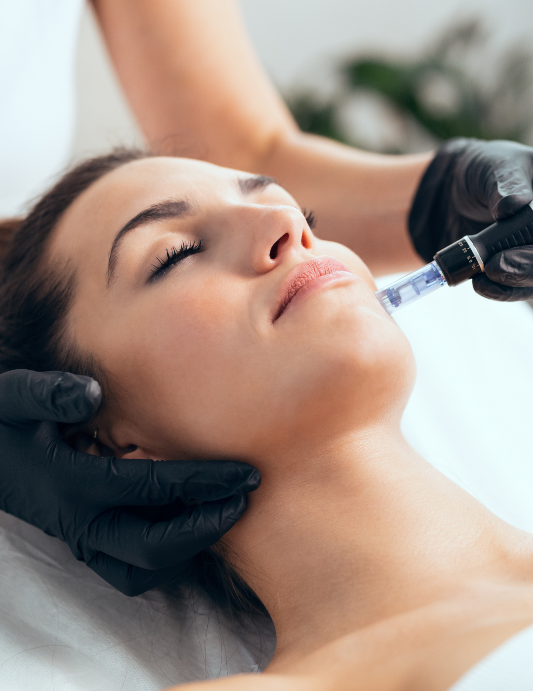 Tratamiento microneedling dermapen
