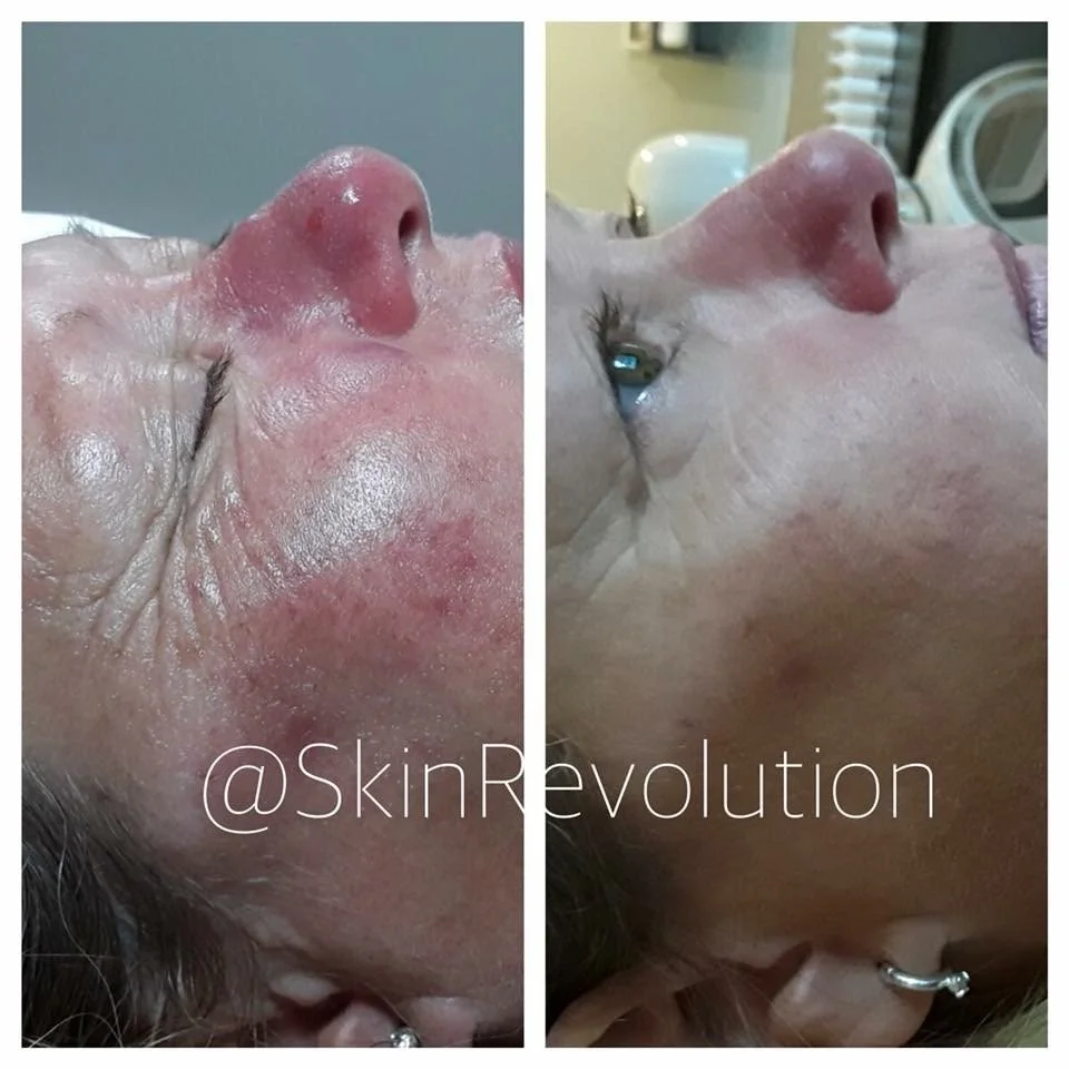 Rosacea Client Story