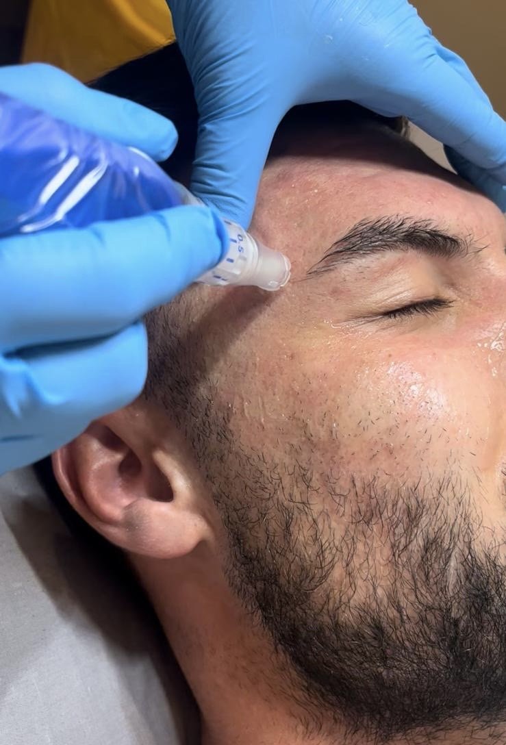 Microneedling Explained: What It Really Feels Like, How It Works, and Why It Doesn't Need to Be Scary