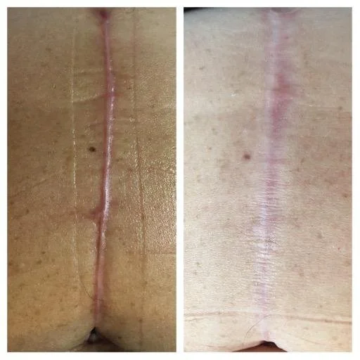 Scar Undergoing treatment