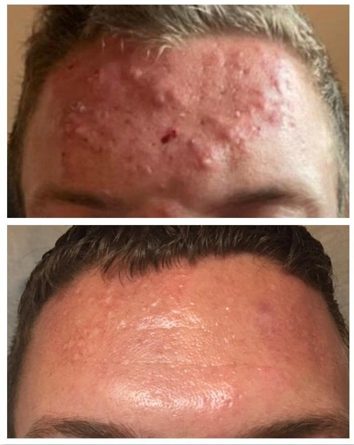 Acne Client Story