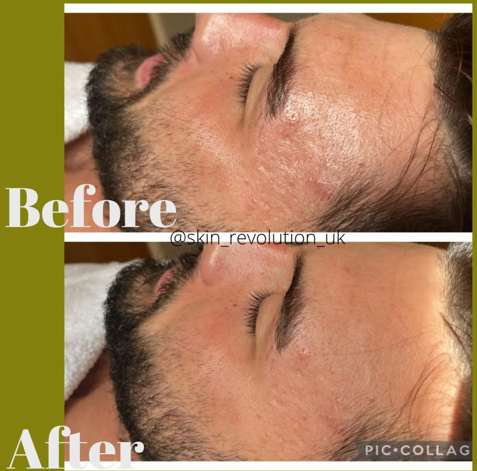 SKIN PEEL TREATMENTS