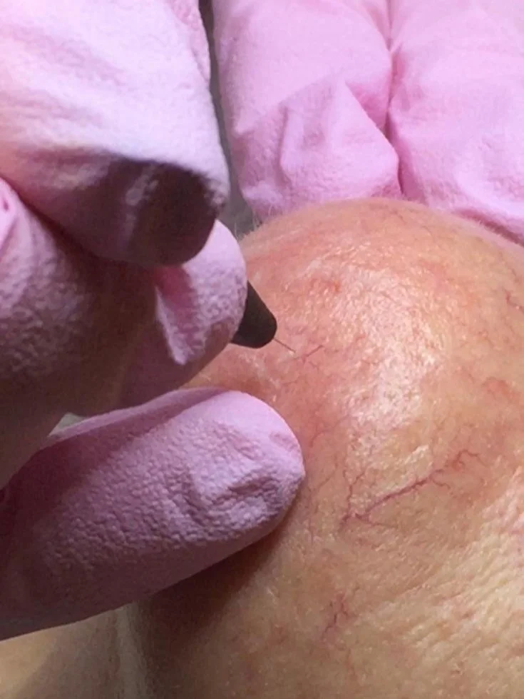 ADVANCED ELECTROLYSIS AND CRYOTHERAPY BLEMISH REMOVAL in essex