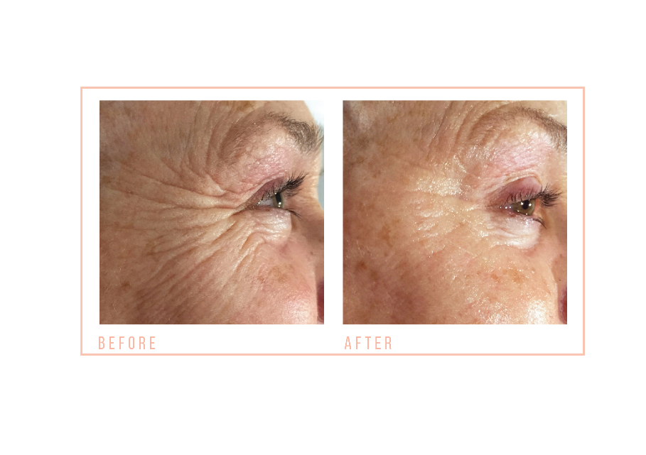 Close-up images showing an eye area with wrinkles in "before" and visibly reduced wrinkles in "after" comparison.
