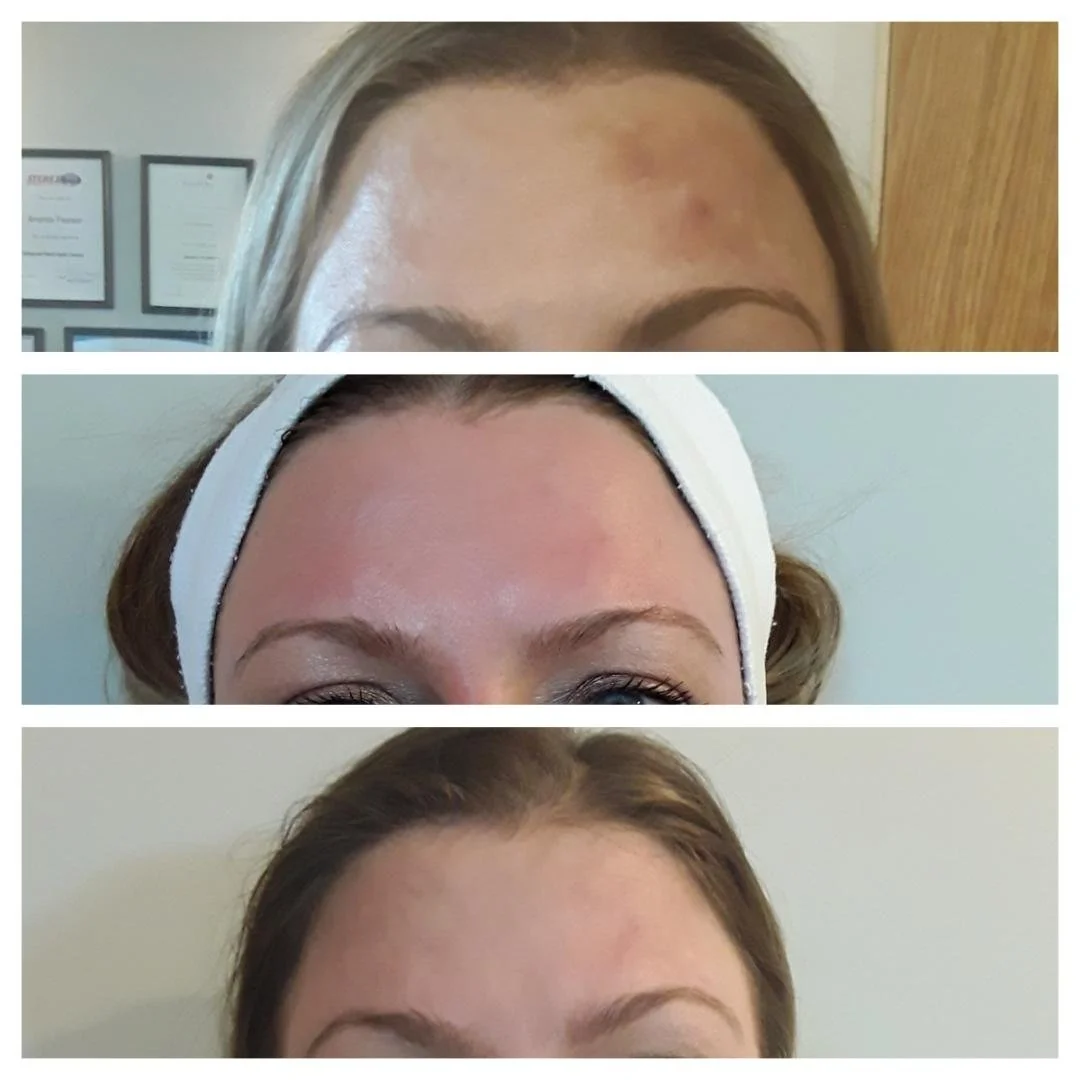Melanoma / Chloasma - Cosmelan De-Pigmentation Client Story
