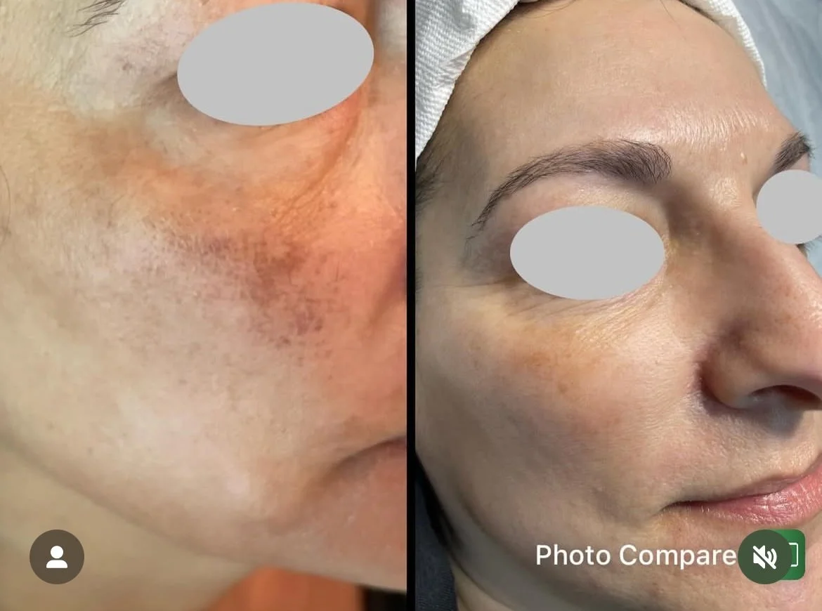 Before and after comparison of facial skin; left side shows skin with redness, uneven tone, and dark spots; right side shows improved, clearer skin with even tone. For Meline Intimate Skin brightening at Keita Beauty in Halifax Nova Scotia