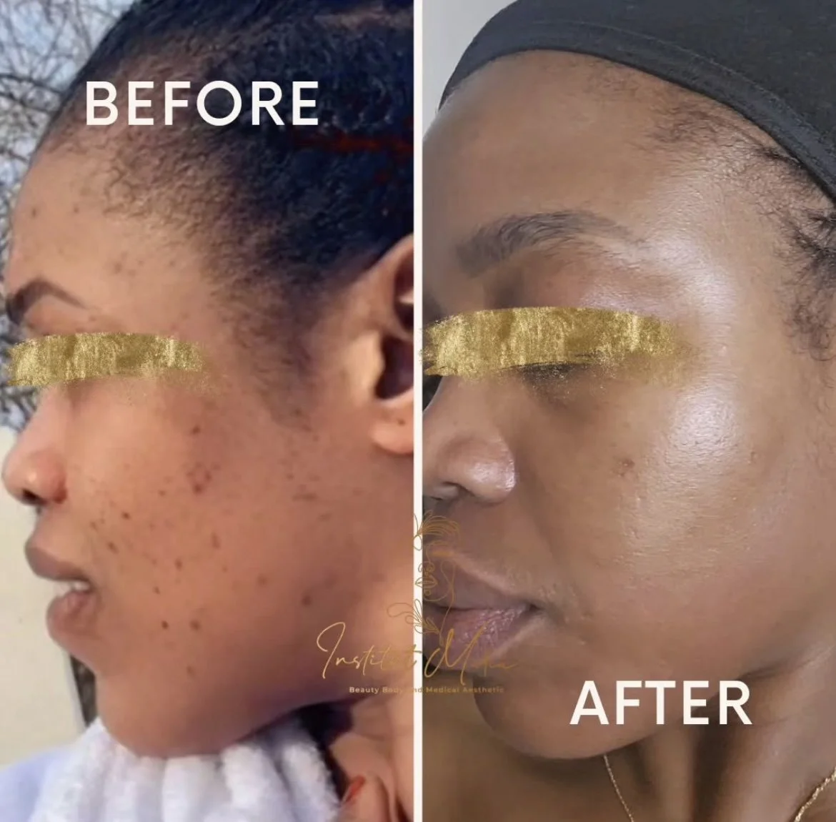 Comparison of a woman's facial skin before and after cosmetic treatment showing clearer, smoother skin in the after photo. For Meline Chemical Peel at Keita Beauty in Halifax Nova Scotia
