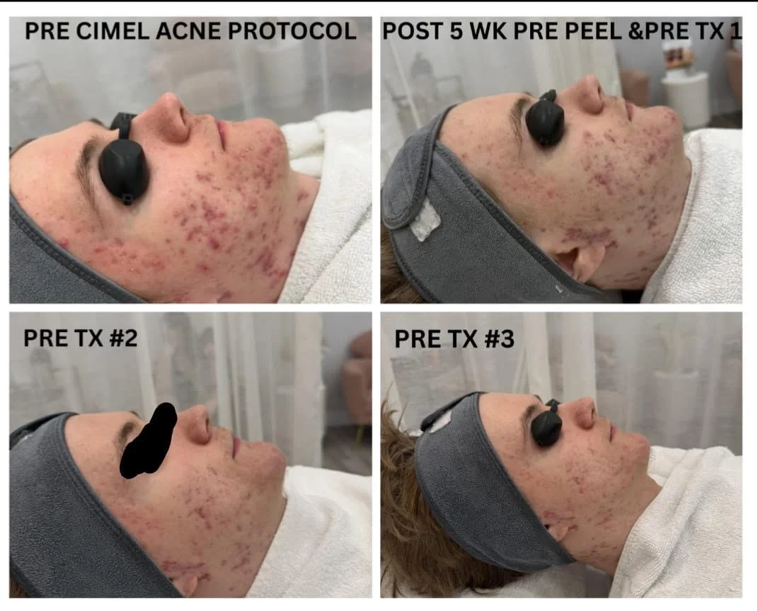 A collage of four photos showing aman's face before and after acne treatments. The top two photos compare skin before treatment and five weeks after, showing significant improvement. The bottom two photos show different pre-treatment skin conditions.