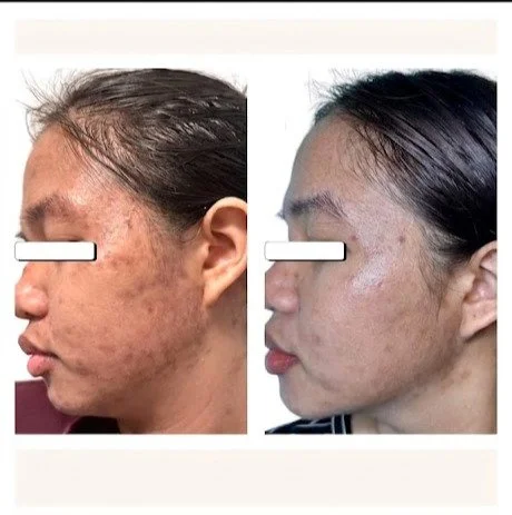 Side-by-side comparison of a woman's face showing reduction in acne scars and skin improvement for Cimel chemical peel at Keita Beauty in Halifax Nova Scotia