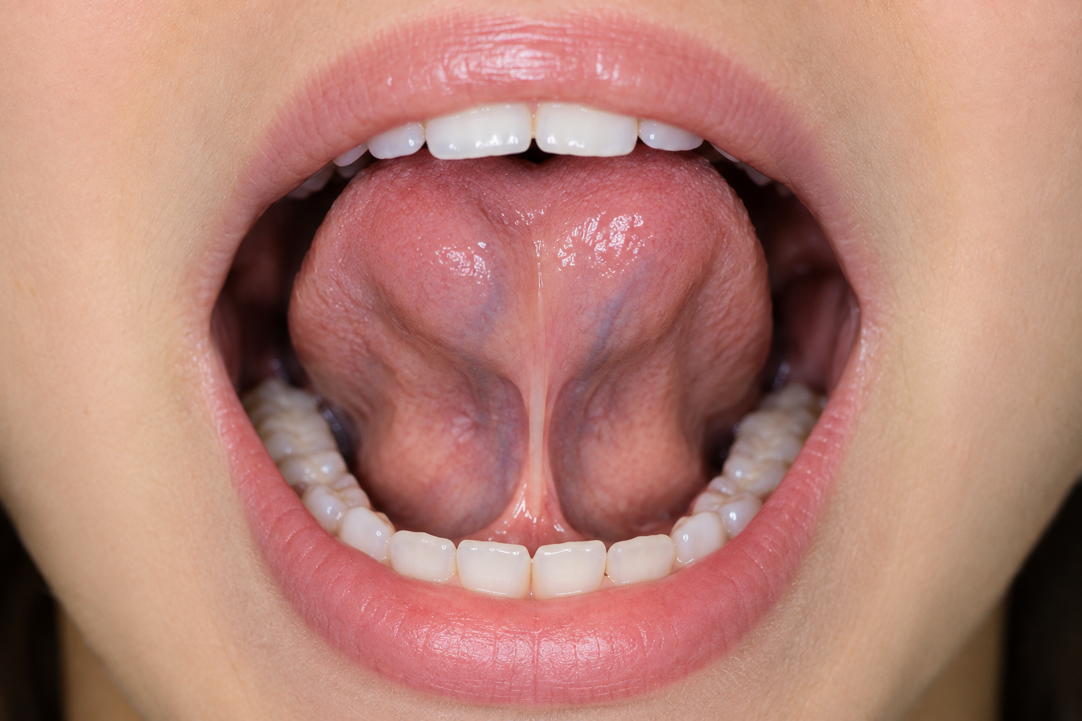 Lingual Frenum Release Therapy