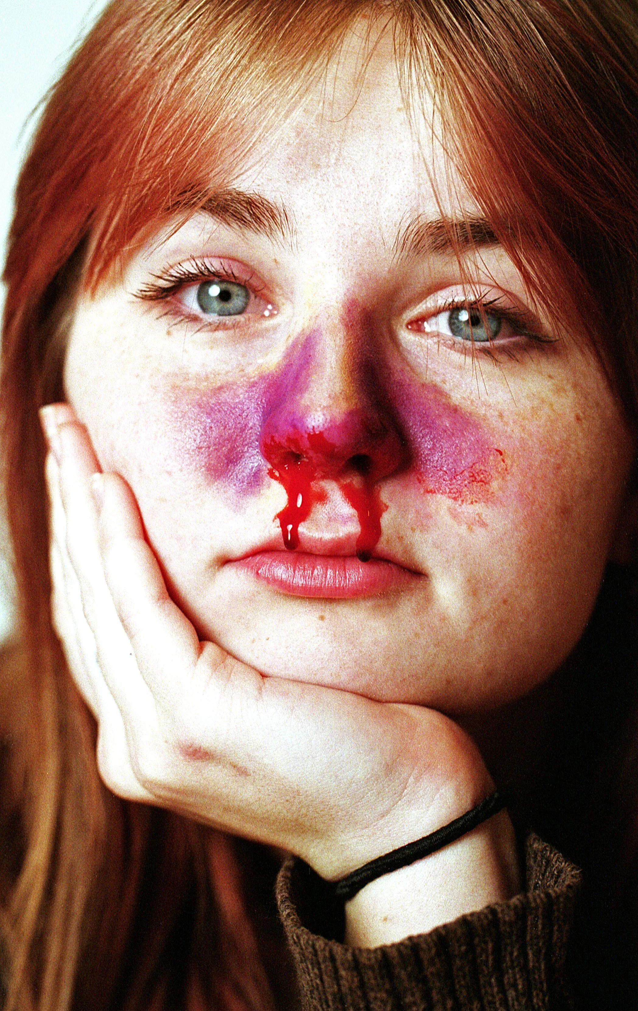 lynn broken nose.JPG