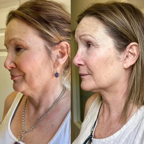 lash lift