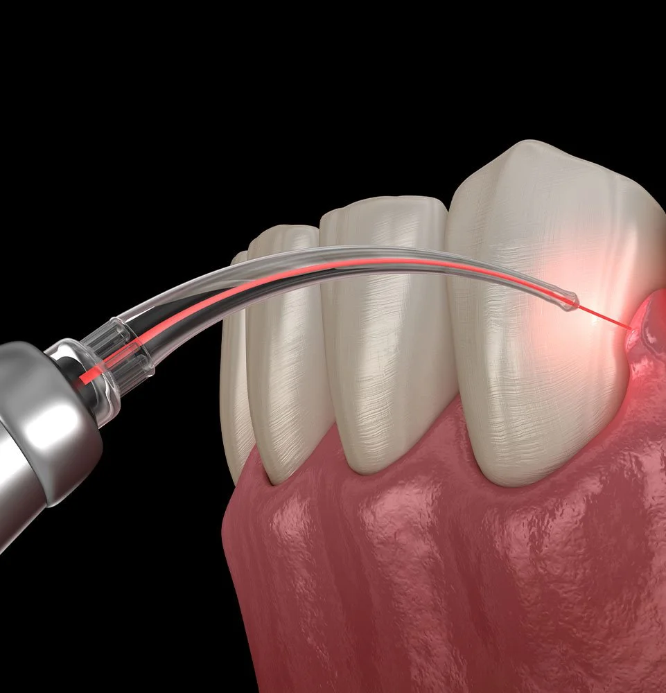 A dental laser procedure being performed on a gum and teeth, with a focused red laser light illuminating the gum area.