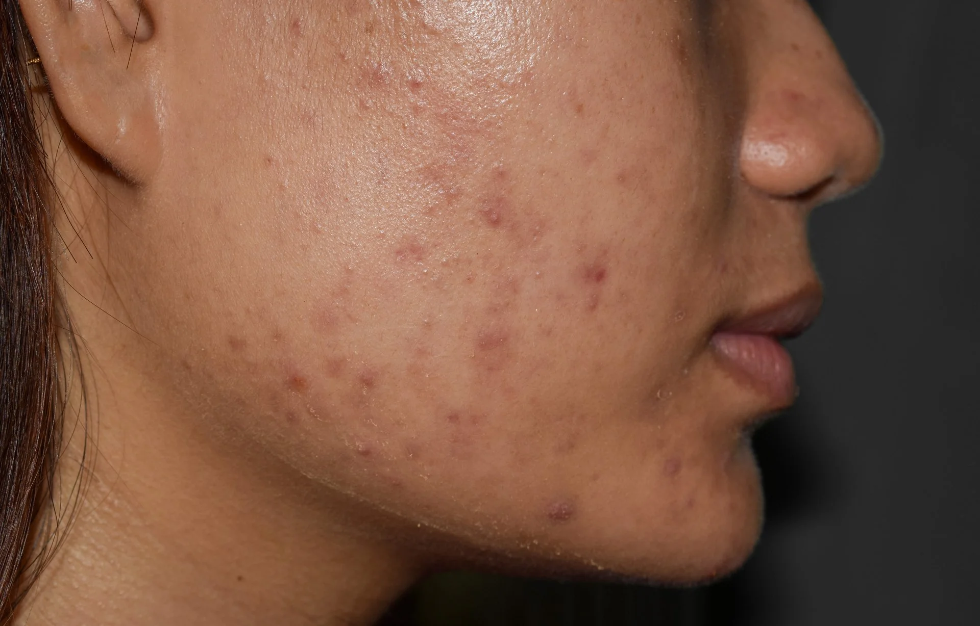 PIE vs. PIH: What’s the difference and why won’t your acne marks go away? 