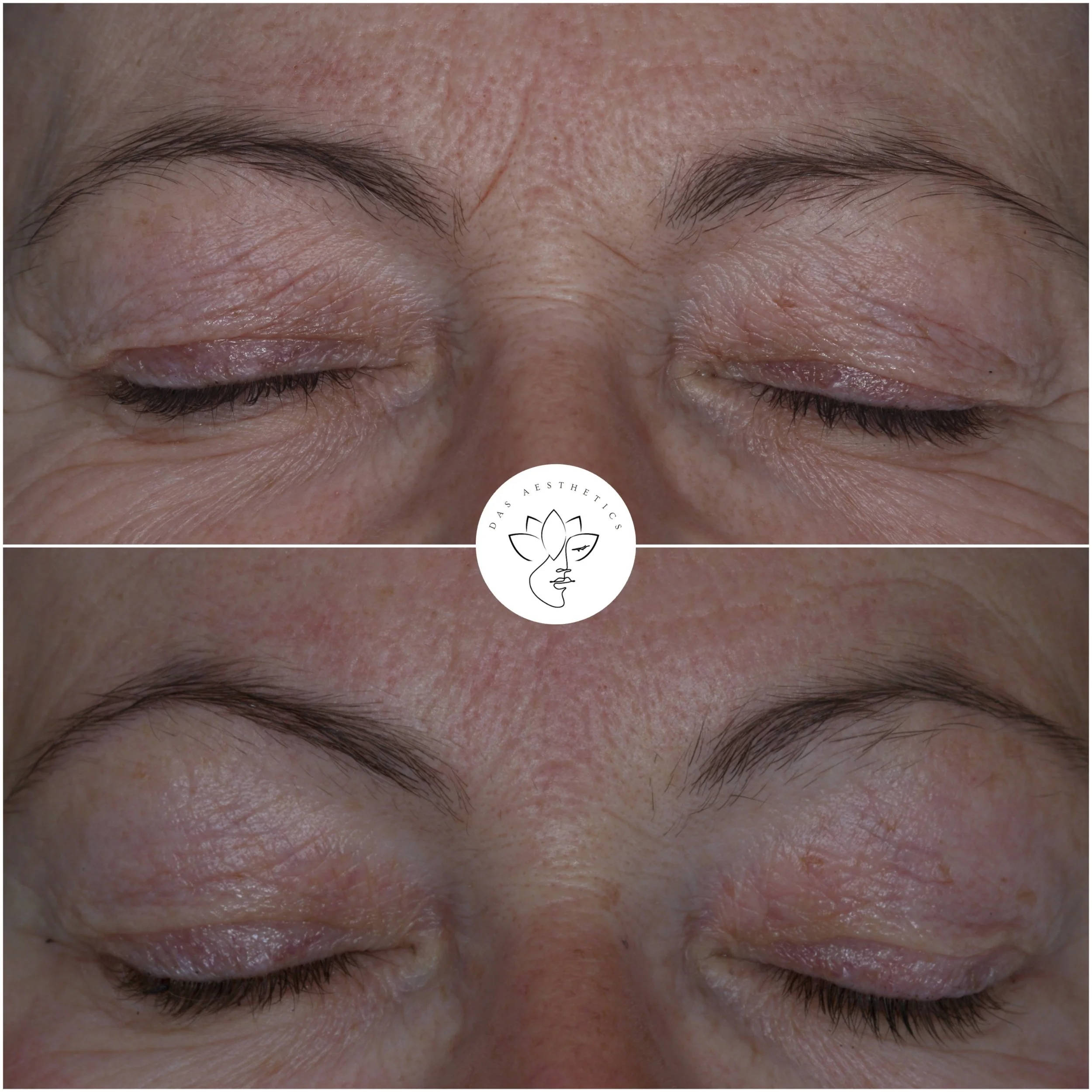 Treatment: Dermal Filler to Frown Lines