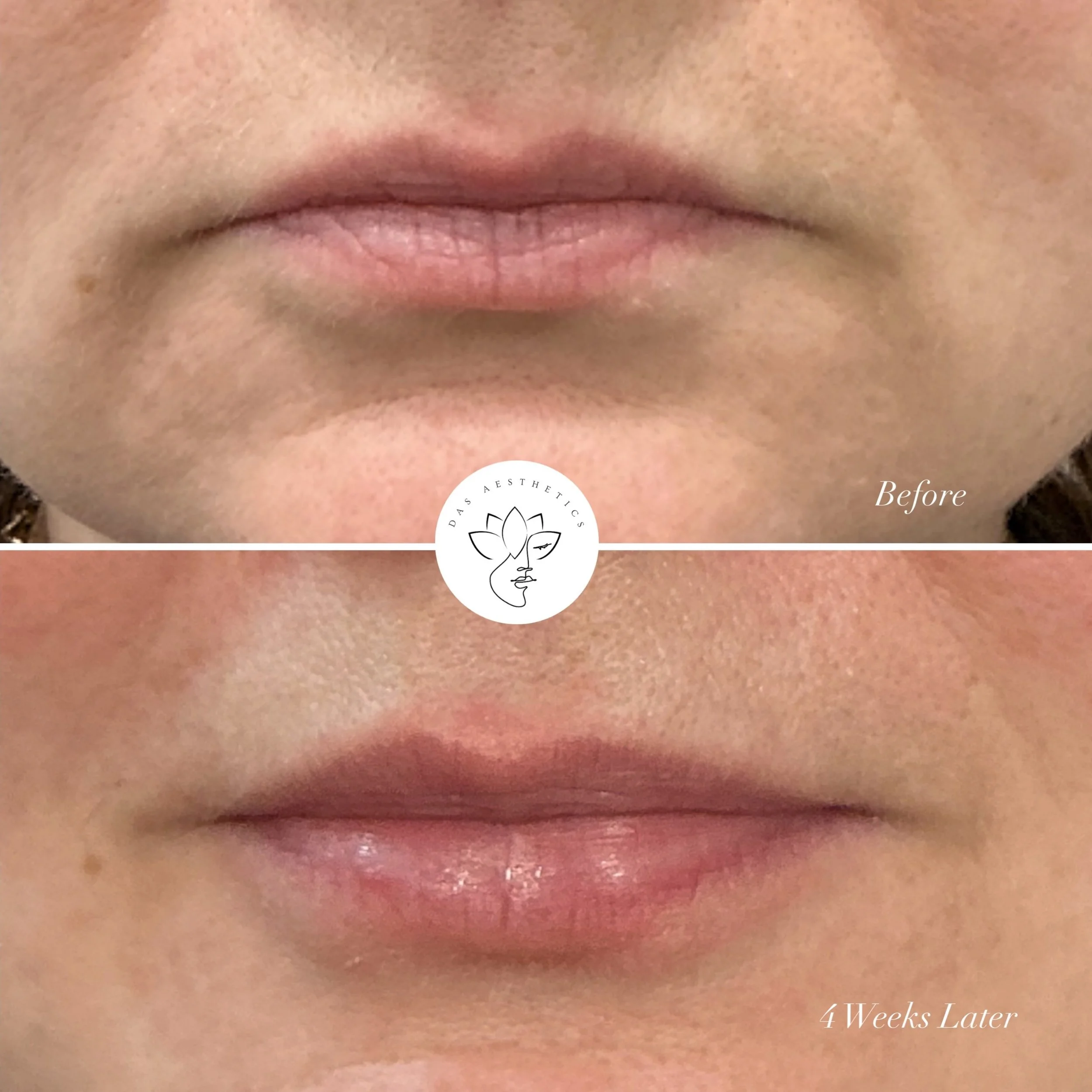 It&rsquo;s officially the season of skin boosters but did you know you can also place them in the LIPS? 👄💦

Check out this incredibly natural result achieved using a skin booster product which creates subtle volume and helps to promote collagen and