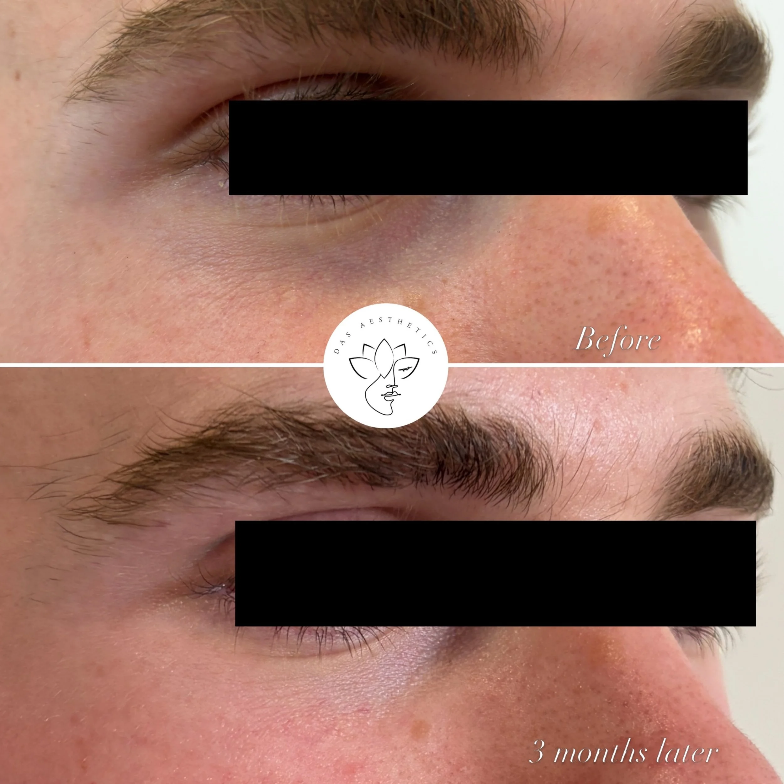 👁️&zwj;🗨️Undereyes, undereyes, undereyes. We universally have the SAME complaints&hellip; skin looking dull, crepey and dark. 

The solution? In majority of cases it&rsquo;s NOT filler! This treatment is SuneKOS Performa: A low-molecular-weight hya