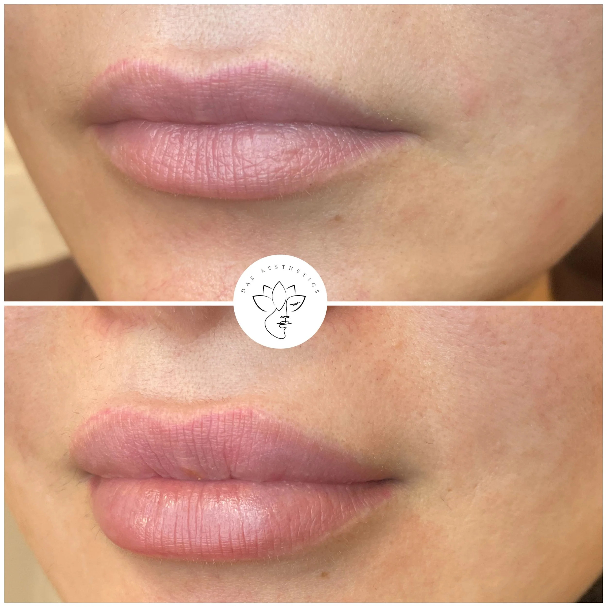 Treatment: Dermal Filler to Lips