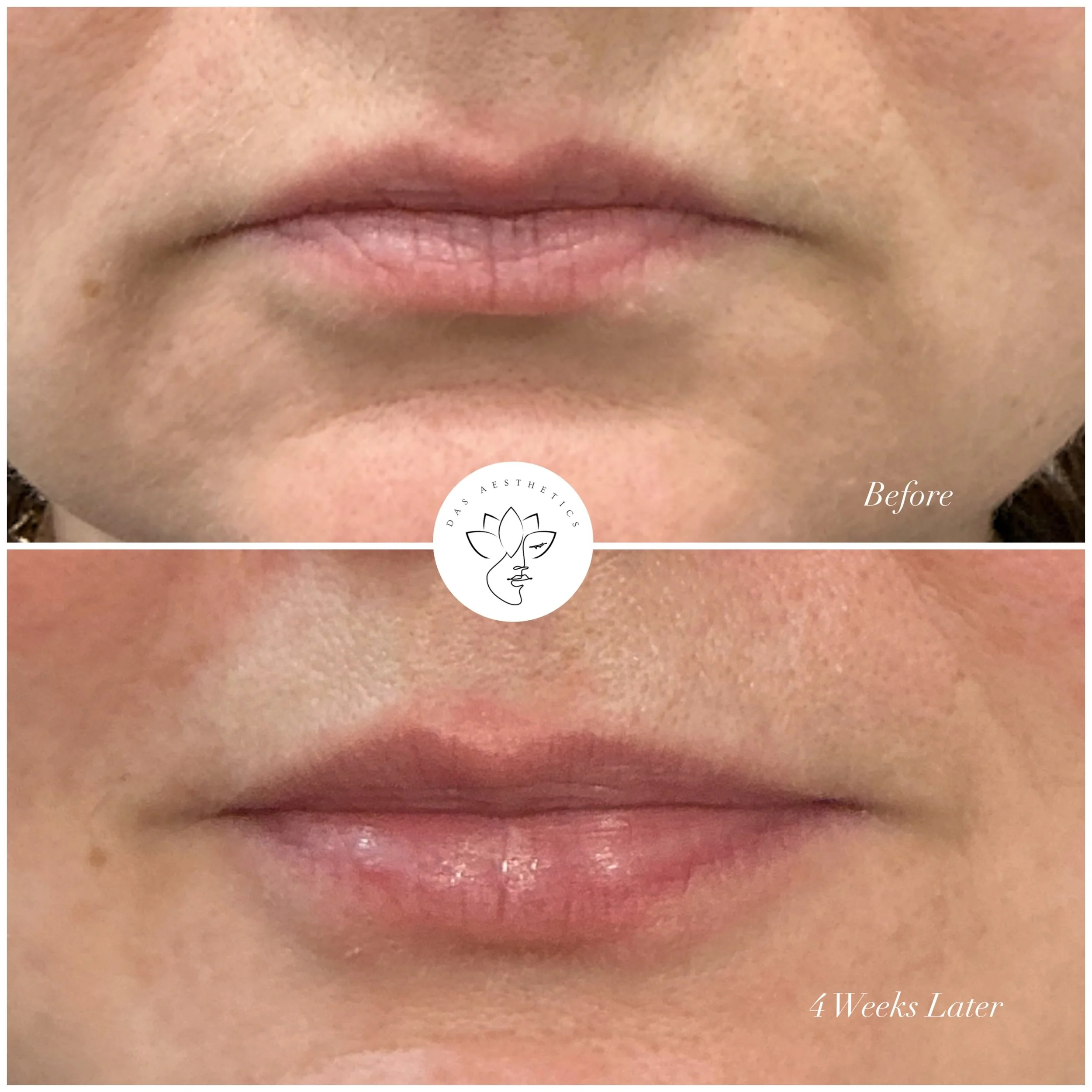 Treatment: Skin Booster to Lips