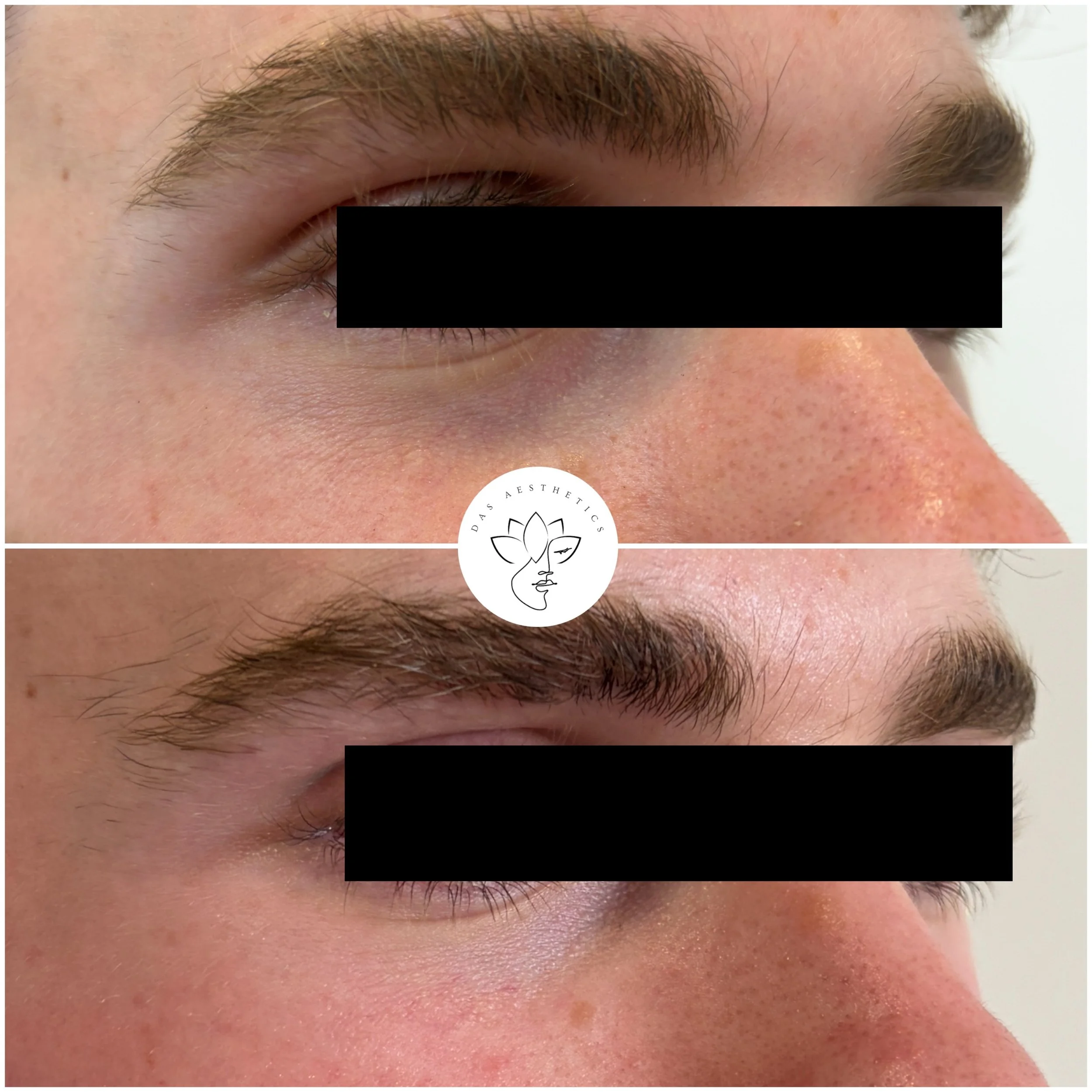 Treatment: SuneKOS for Undereyes