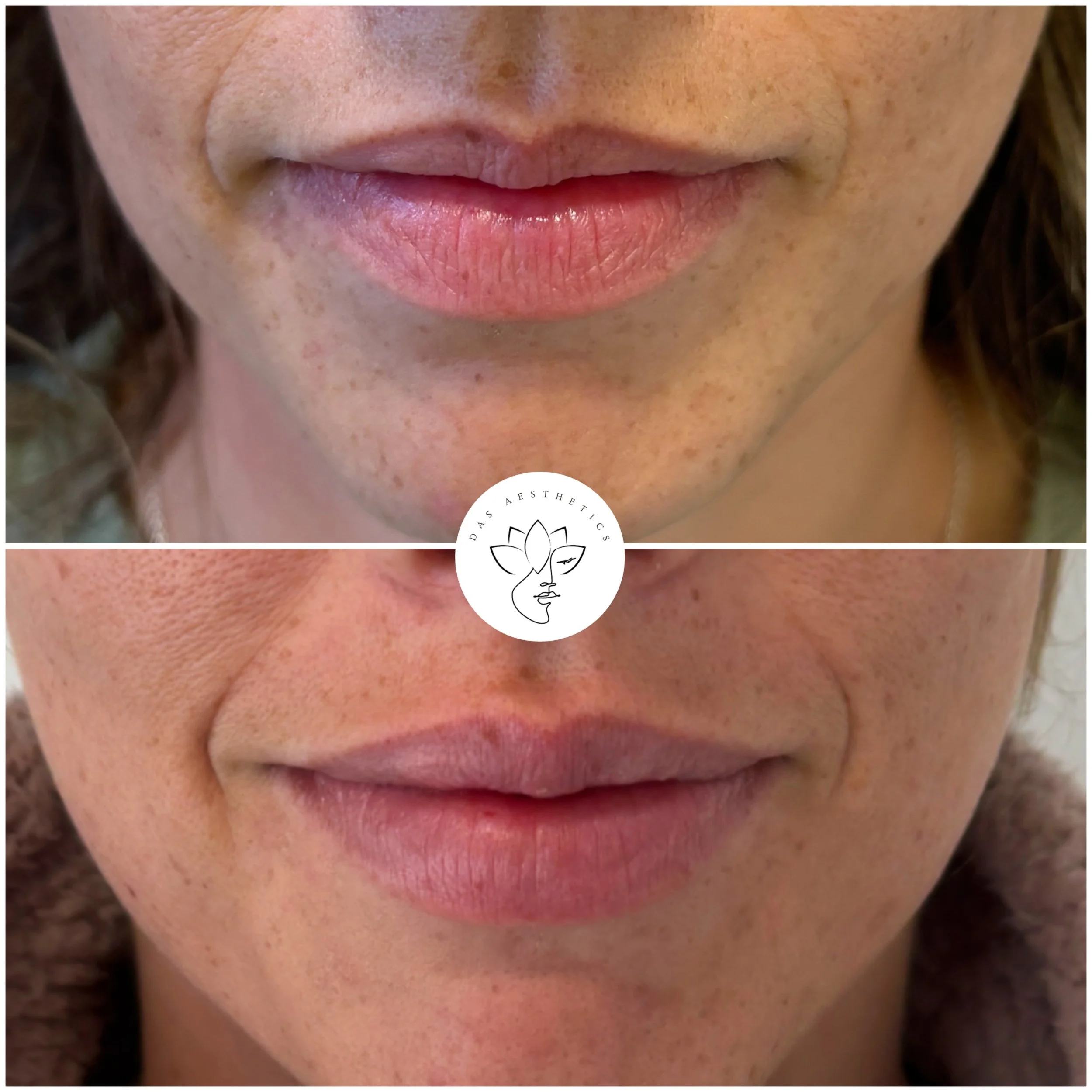 Treatment: Dermal Filler to Lips