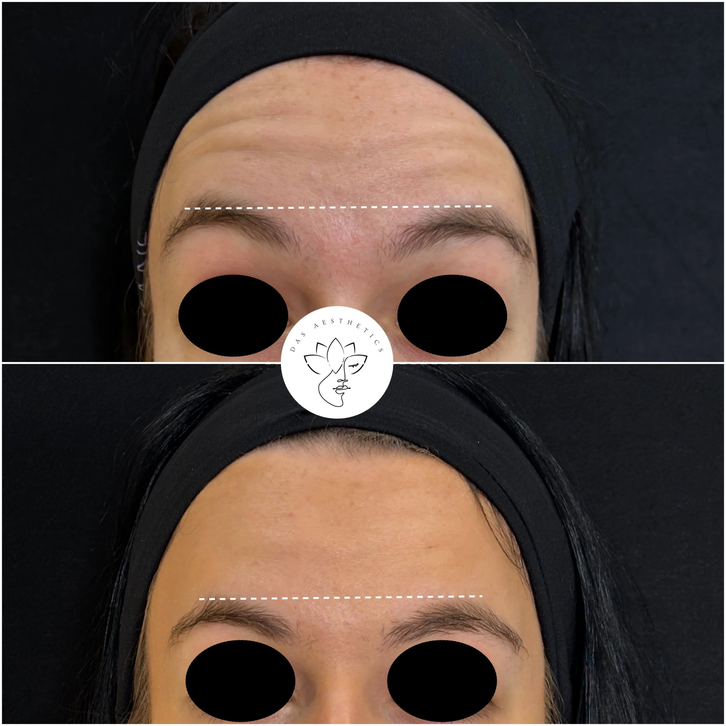 Treatment: Botox to Improve Brow Symmetry