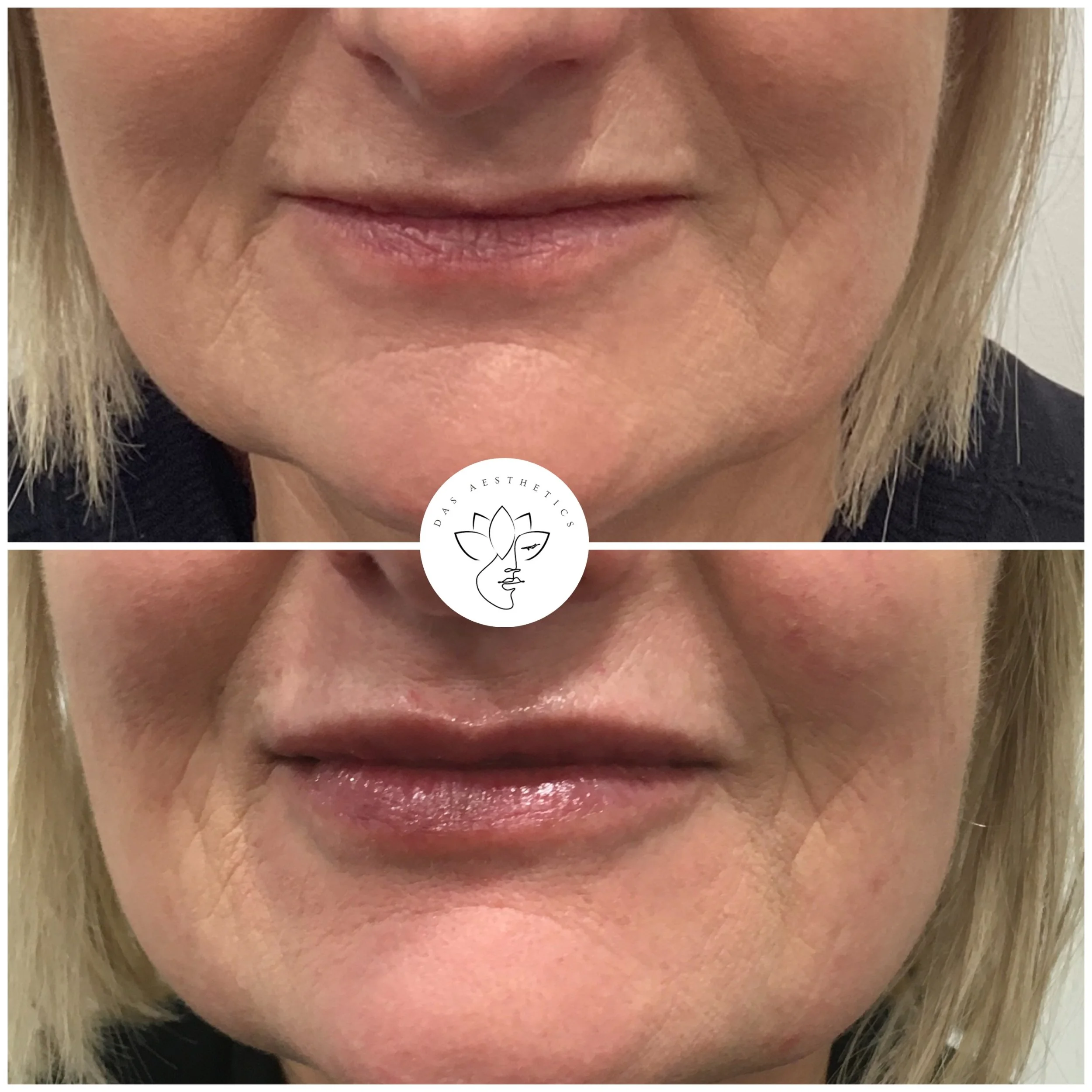 Treatment: Perioral Rejuvenation