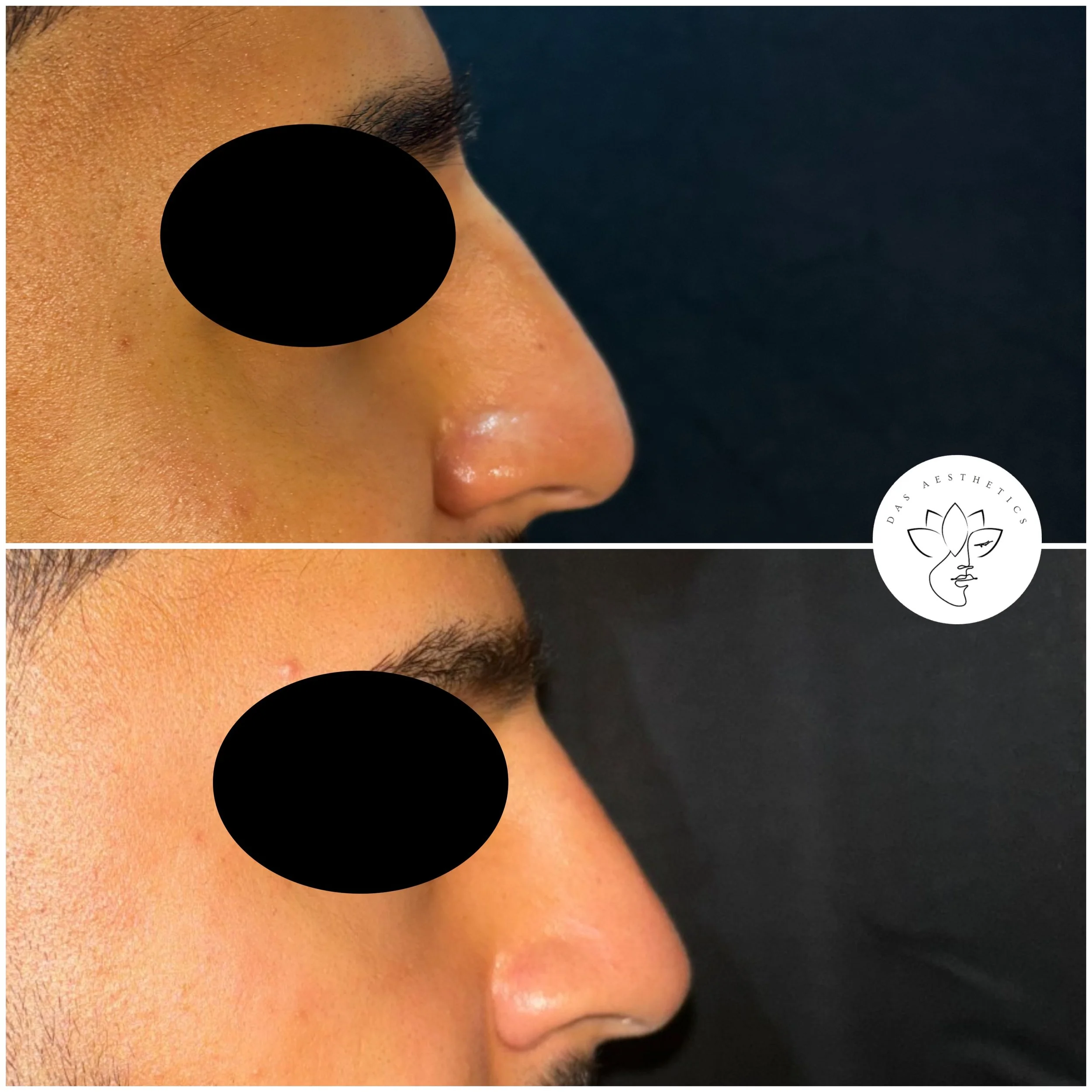 Treatment: Non-Surgical Rhinoplasty 