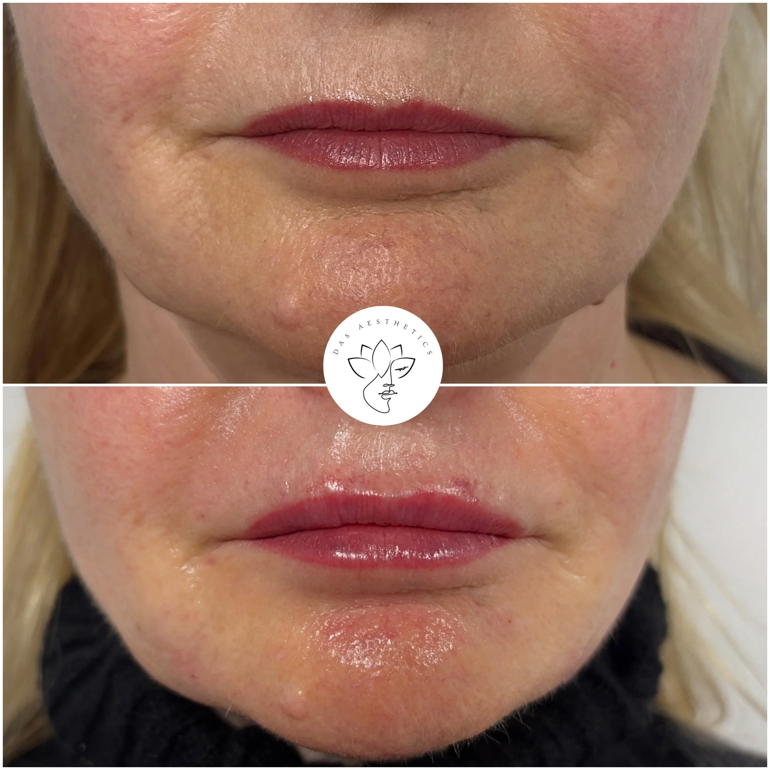 Treatment: Perioral Rejuvenation