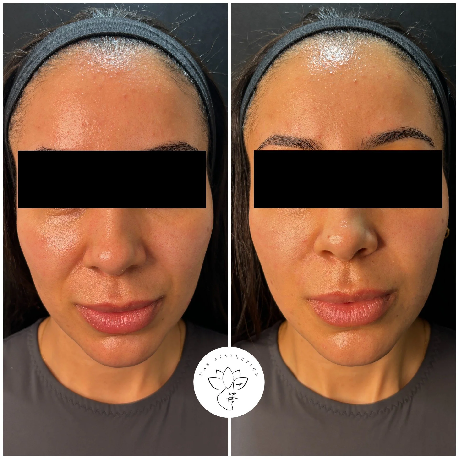 Treatment: Midface Dermal Filler 
