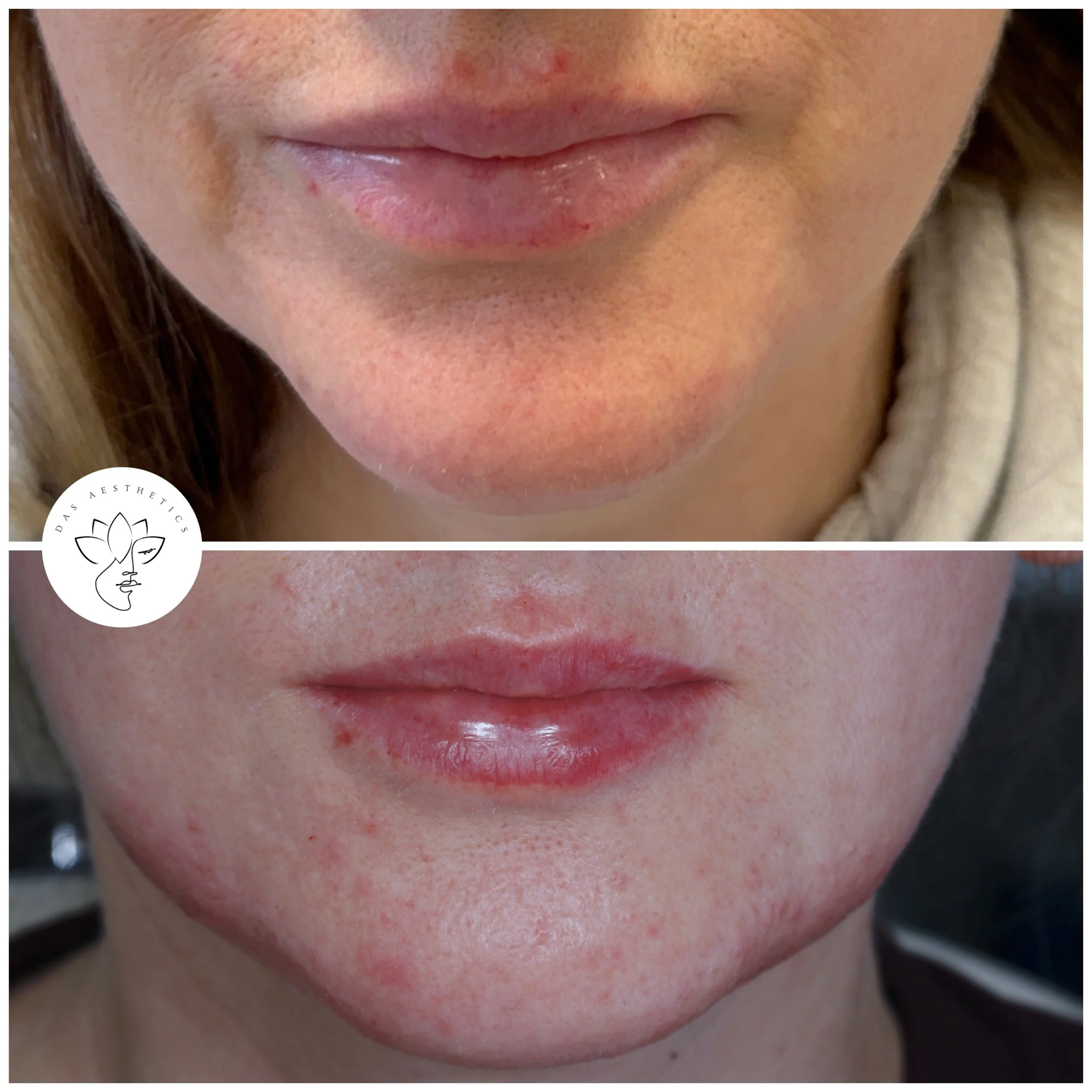 Treatment: Dermal Filler to Lips and Jawline