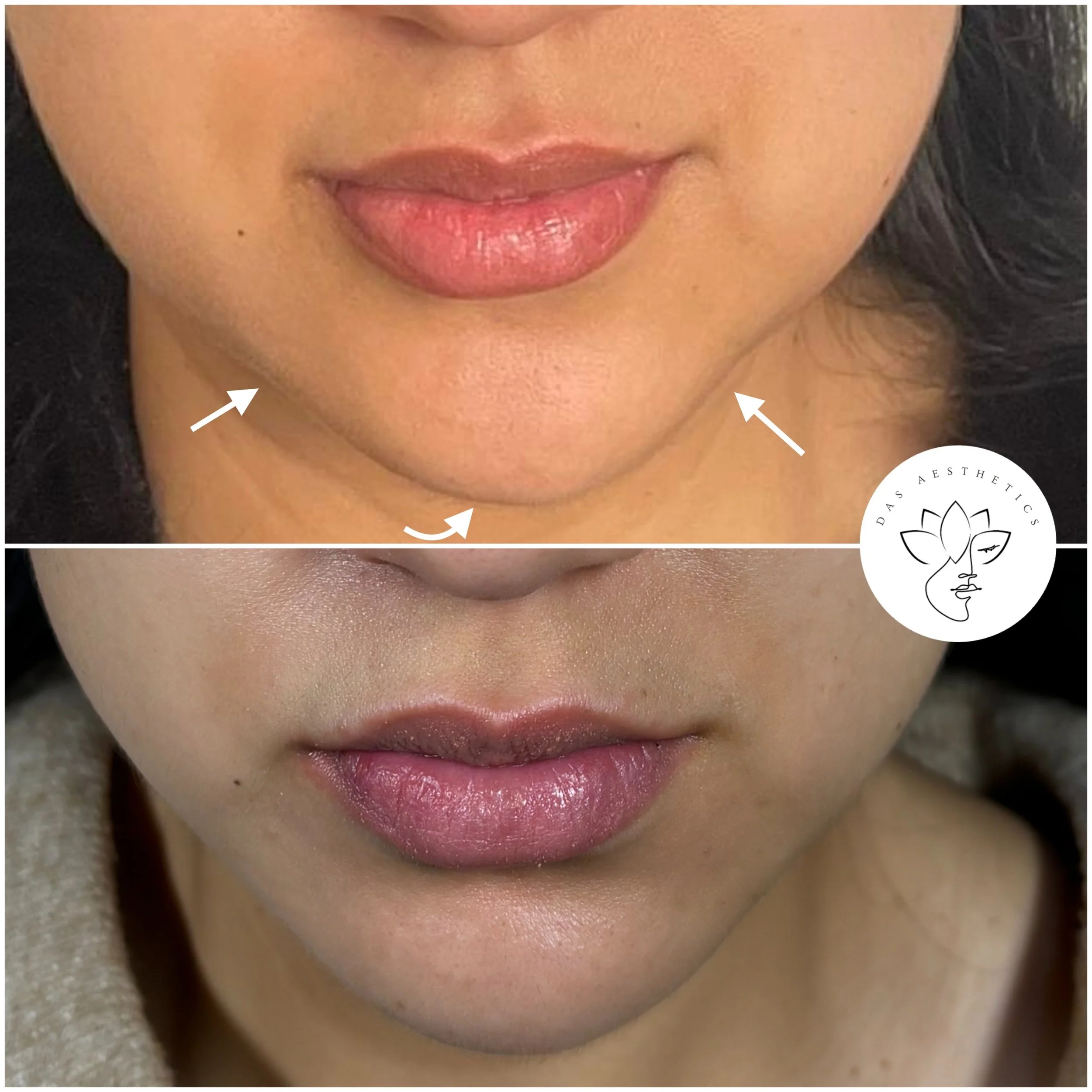Treatment: Lower Face Balancing
