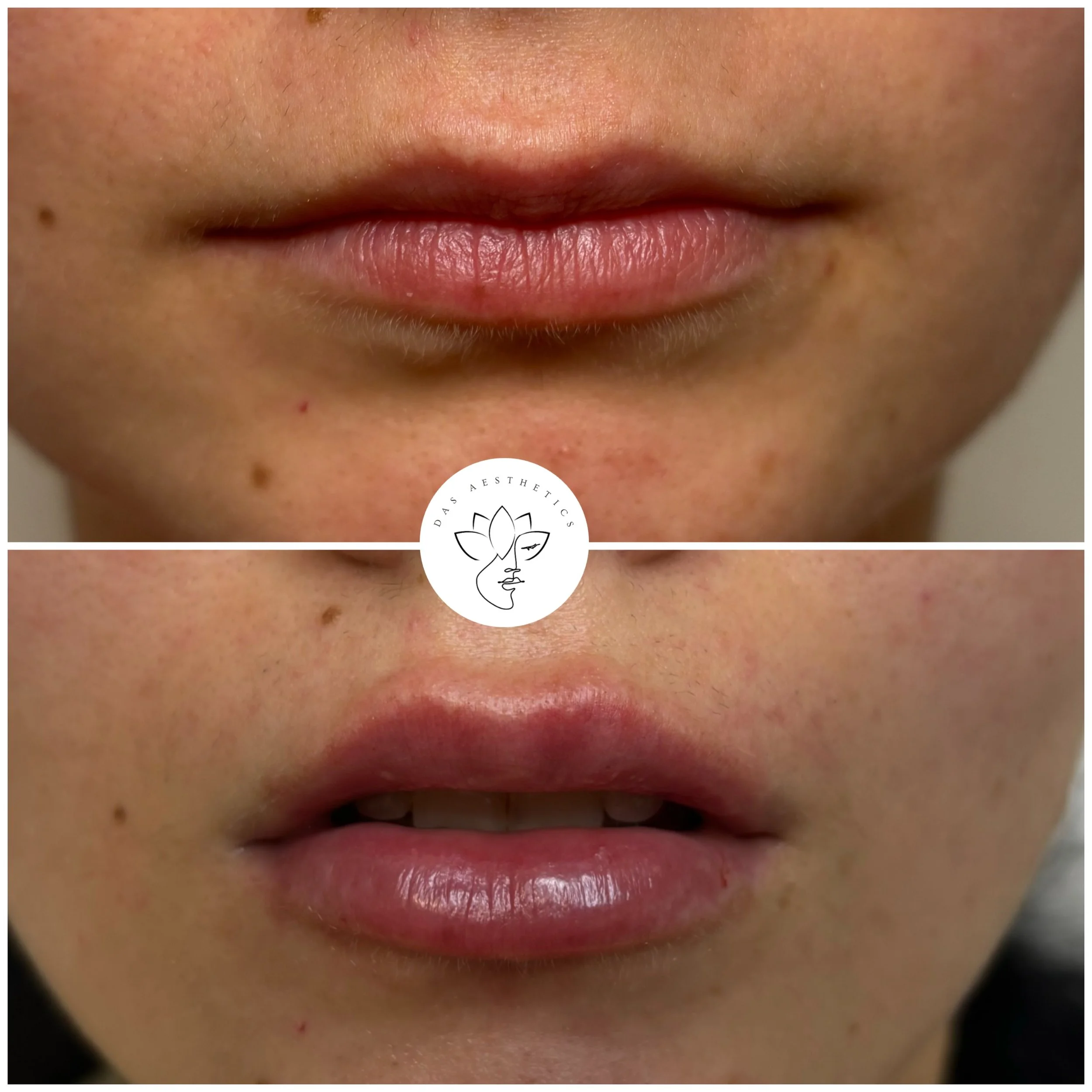 Treatment: Dermal Filler to Lips