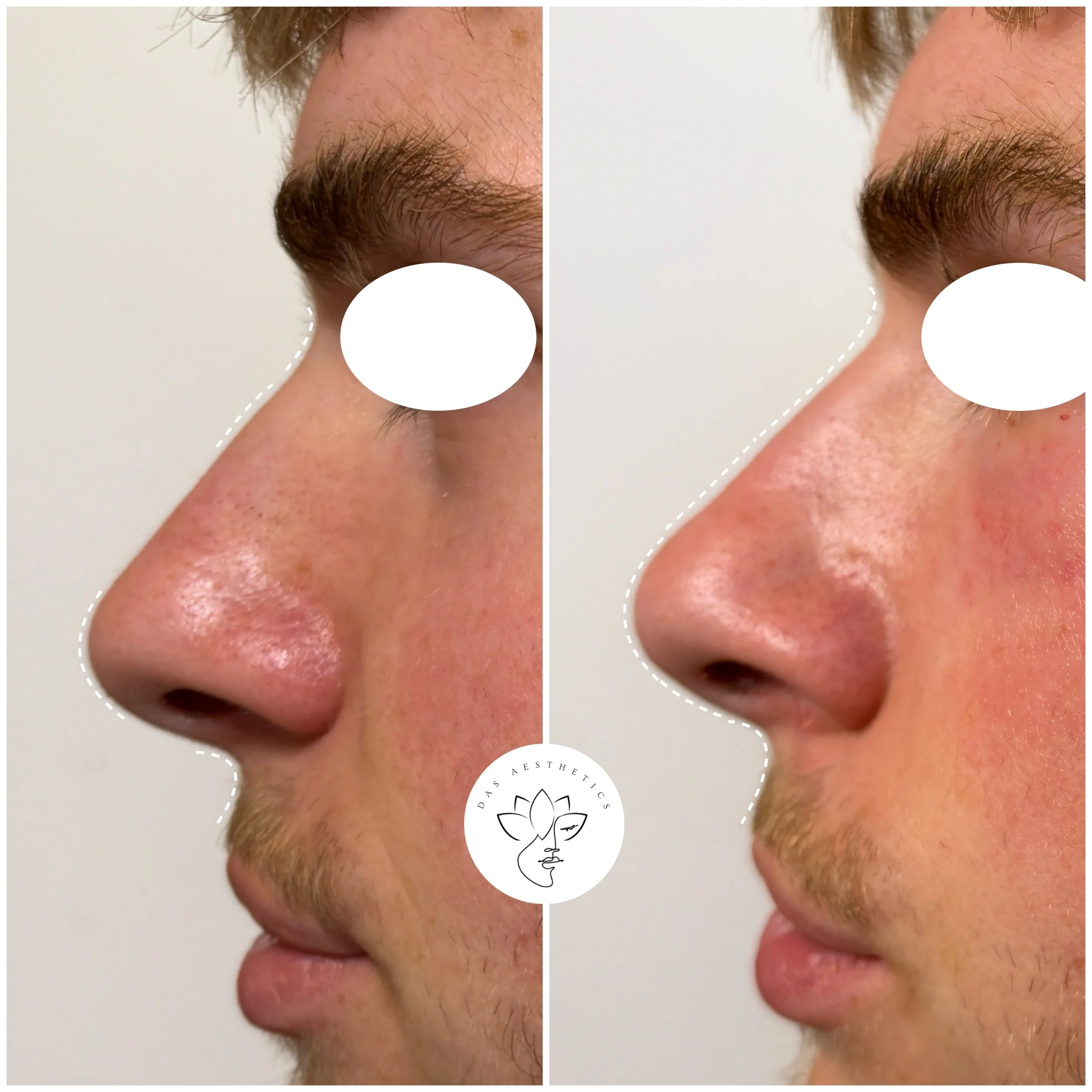 Treatment: Non-Surgical Rhinoplasty 