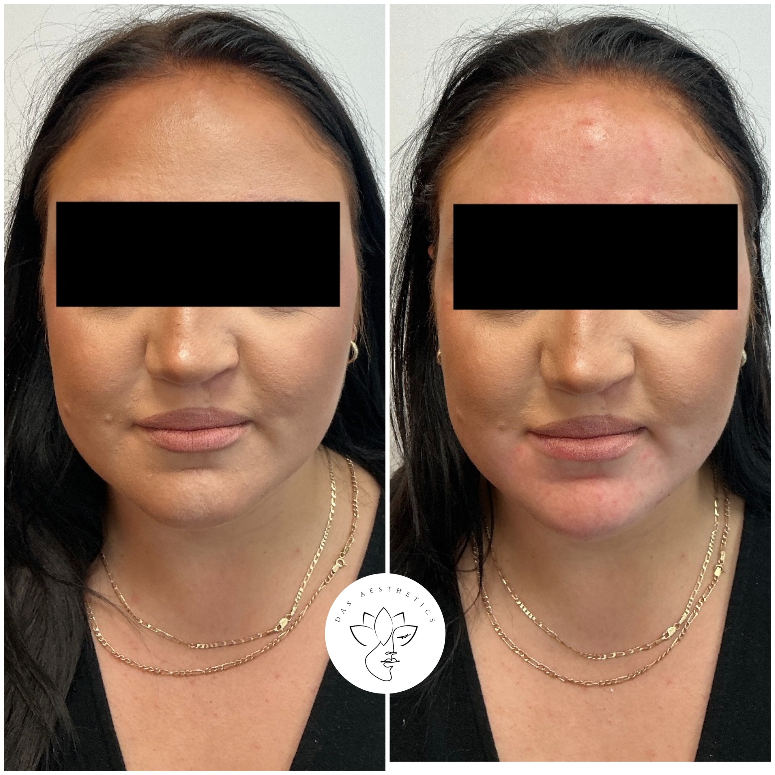 Treatment: Chin Filler