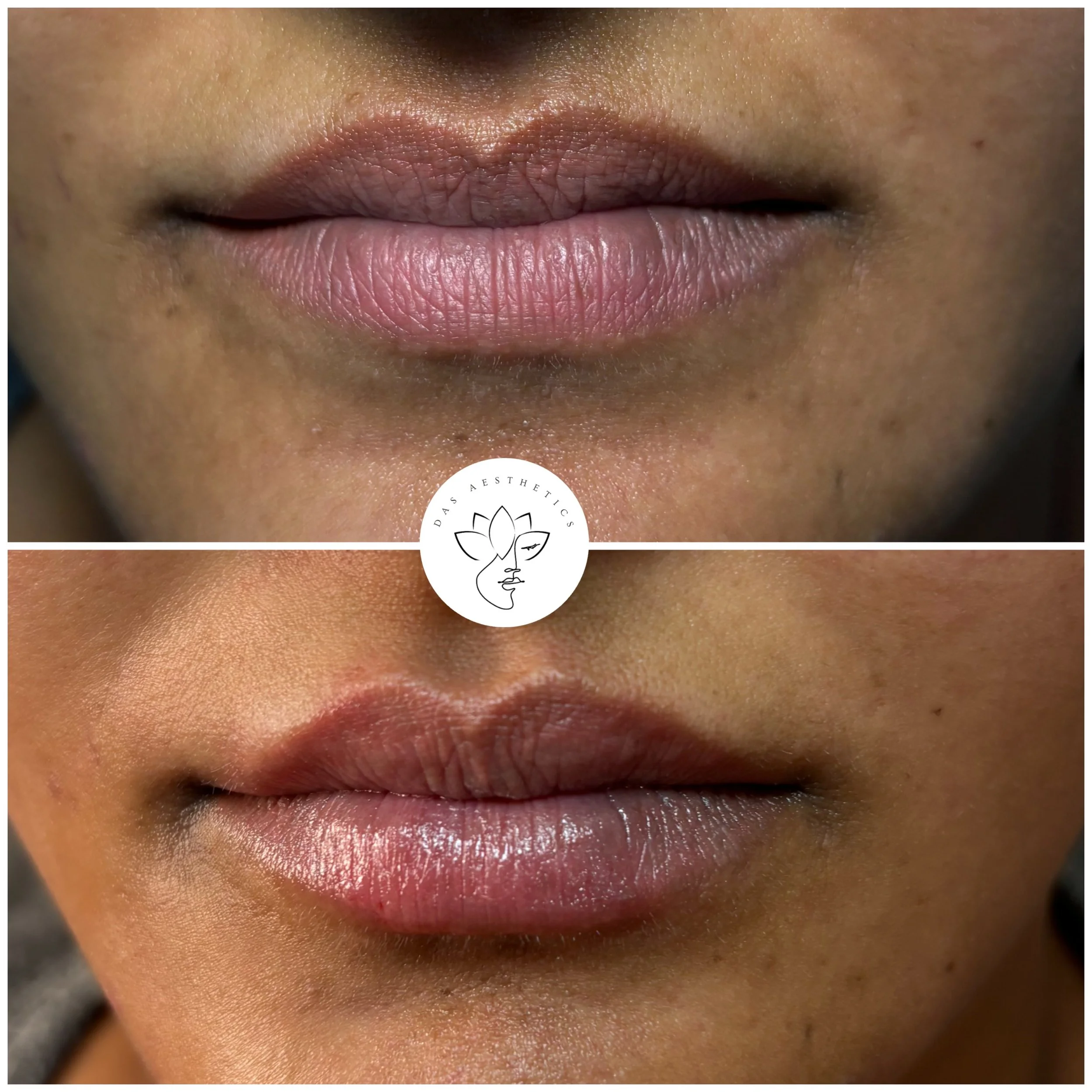 Treatment: Dermal Filler to Lips
