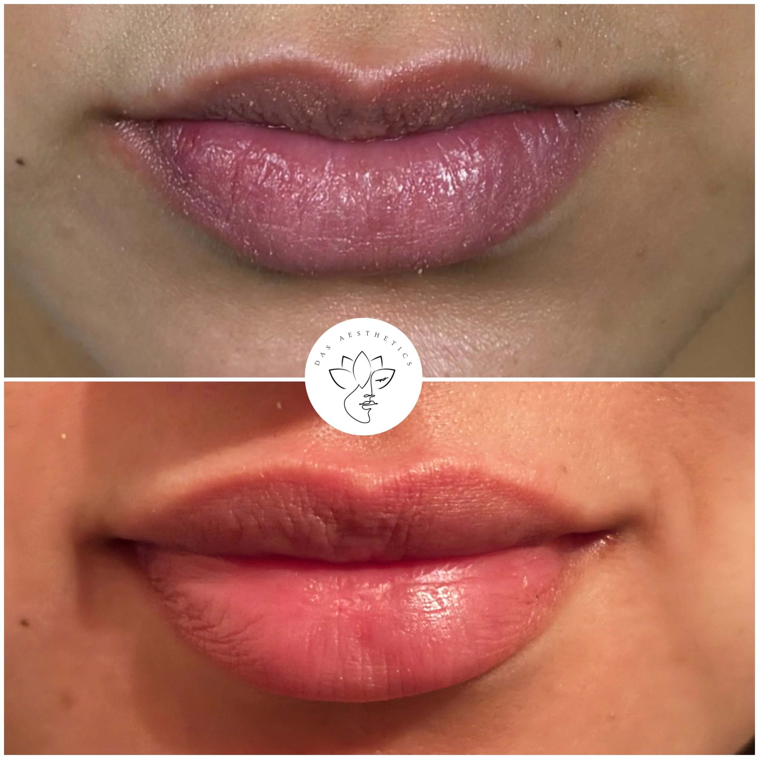 Treatment: Dissolving + Dermal Filler to Lips