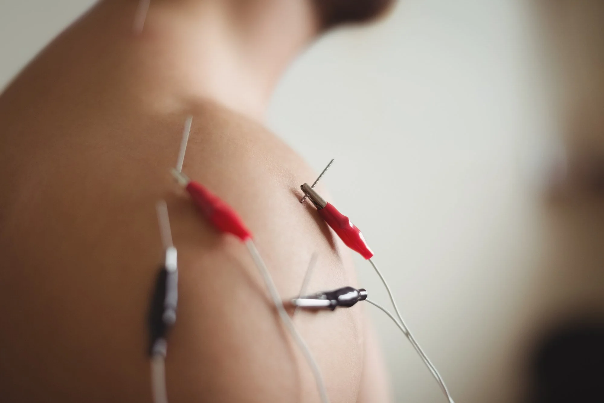 Close-up of acupuncture needles inserted into a person's skin for treatment.