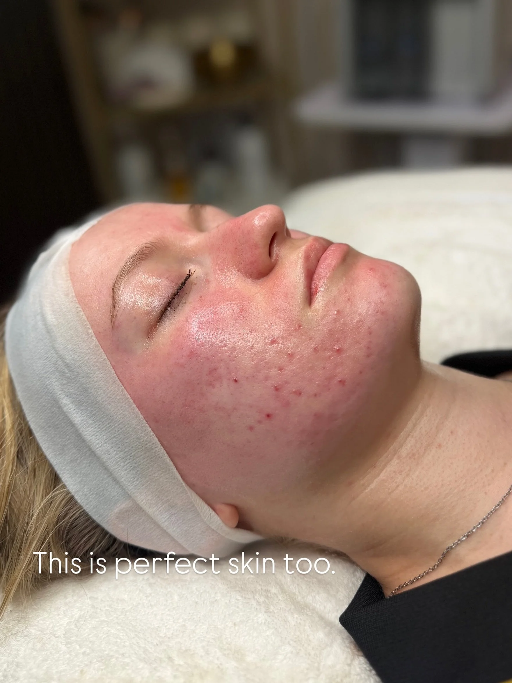 THIS IS PERFECT SKIN TOO 🤍

Skin isn&rsquo;t always going to be completely clear, poreless and &ldquo;pitch perfect&rdquo; &mdash; and that&rsquo;s completely normal.

This client came to me with redness, congestion and acne scarring, but most impor