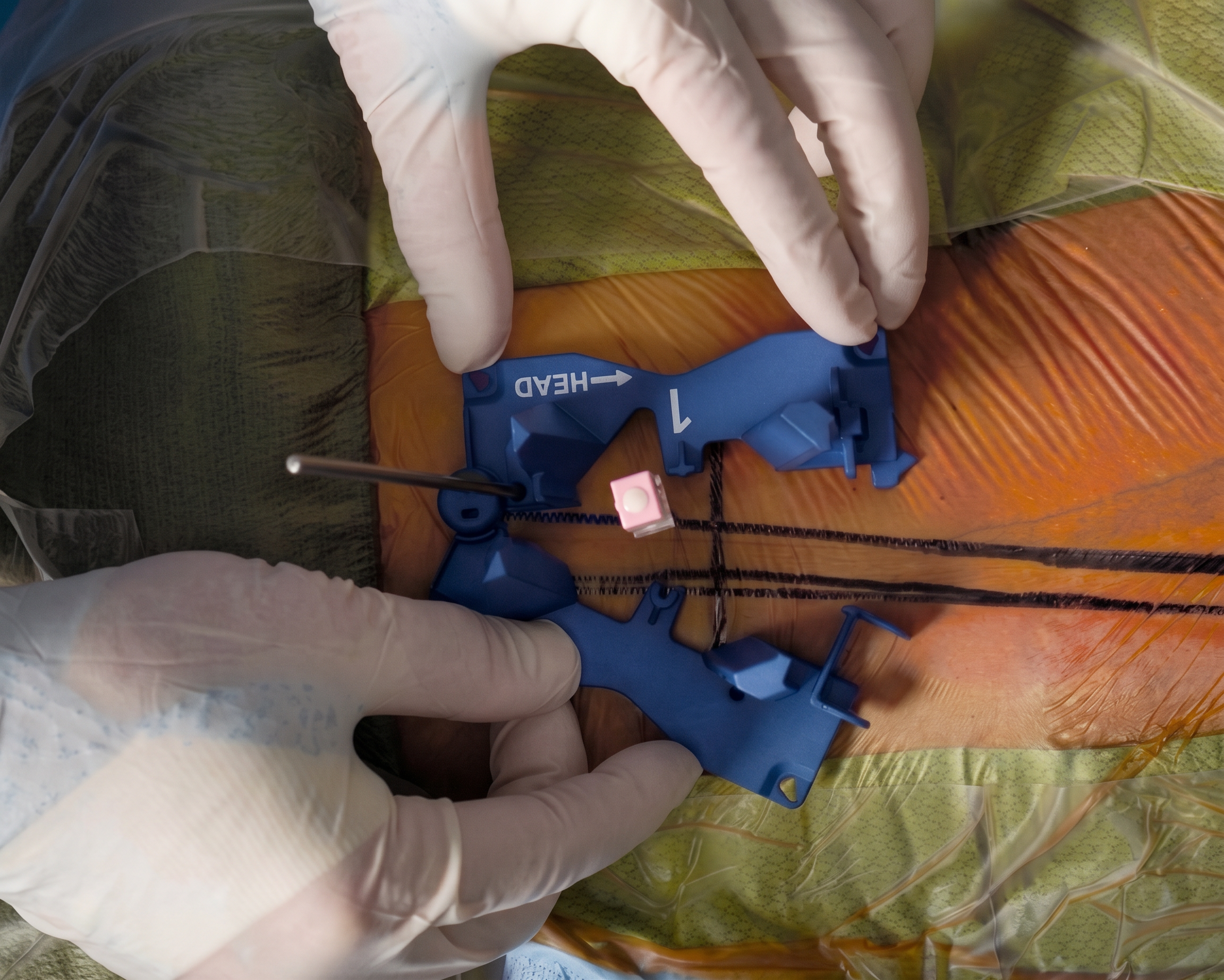 A person wearing gloves is using a medical instrument, possibly for a procedure, with a medical tray or container in the background.