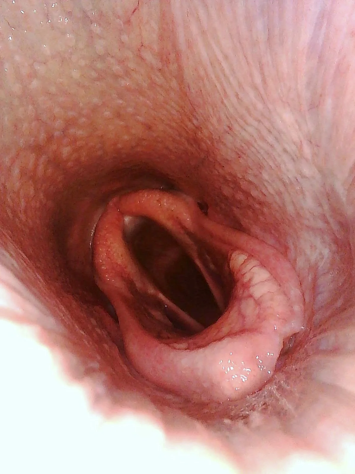 Close-up of a human throat with the uvula and tonsils visible.