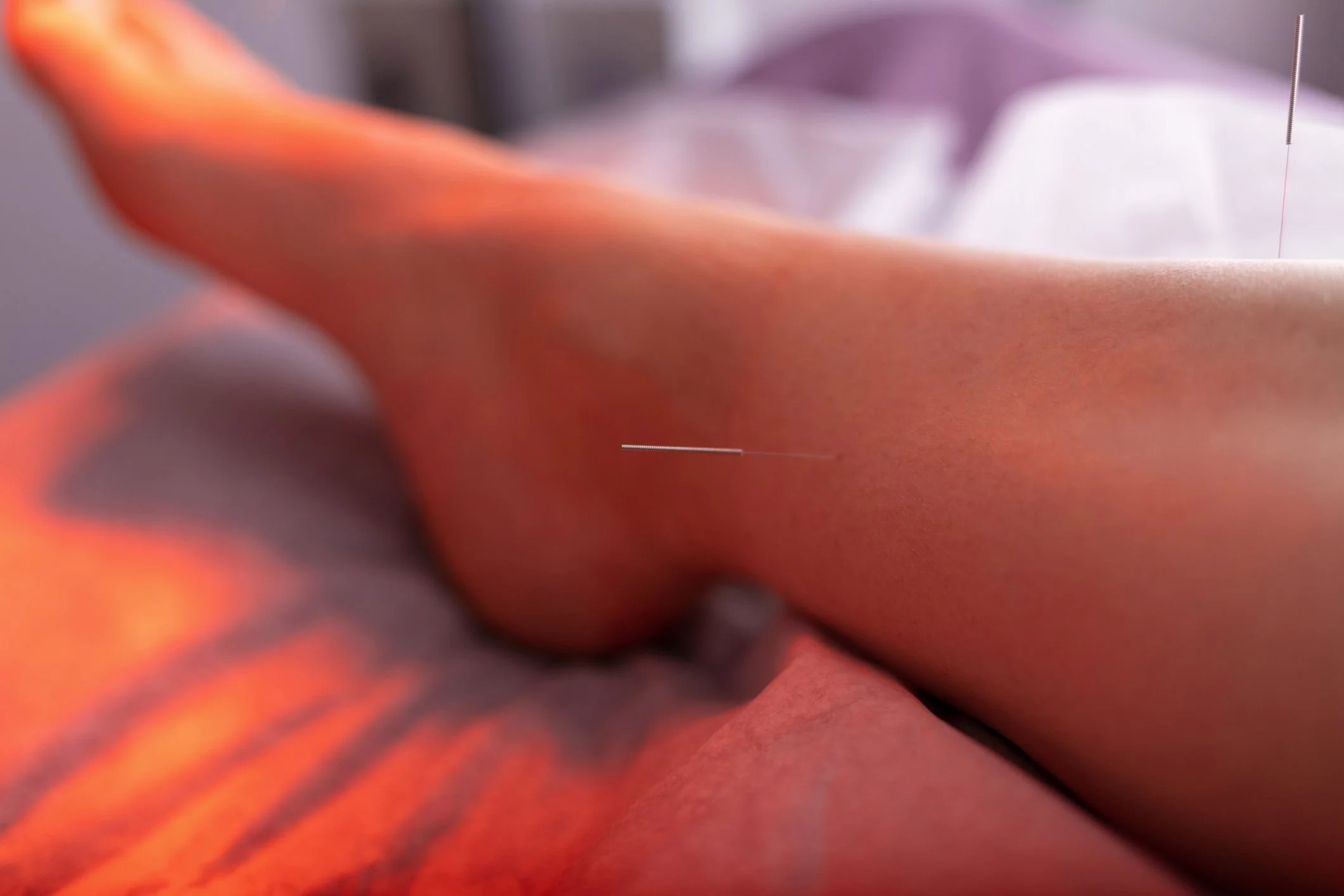 Close-up image of a person's bare arm with an acupuncture needle inserted in their skin.