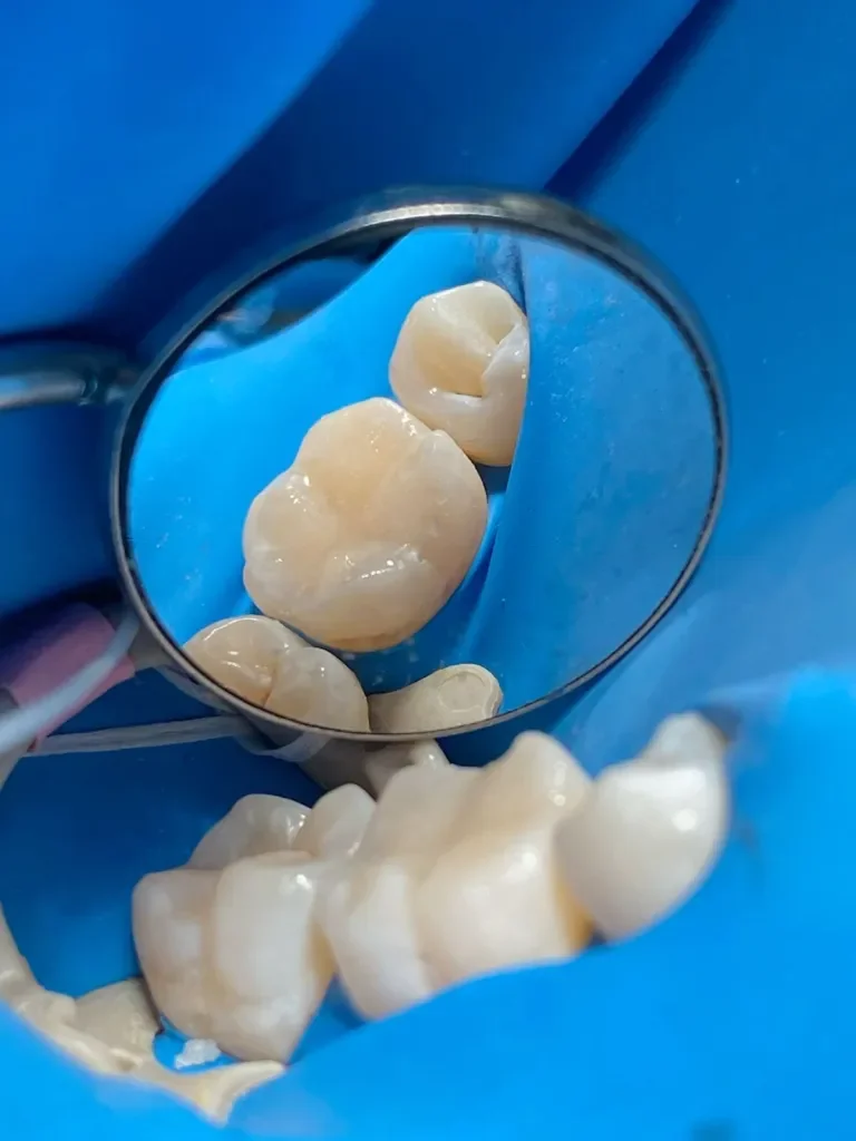 Resina dental