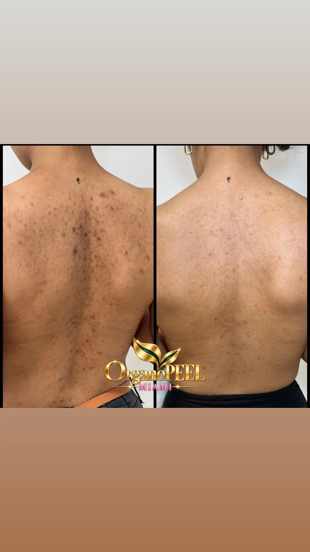 Back skin before and after Organo Peel