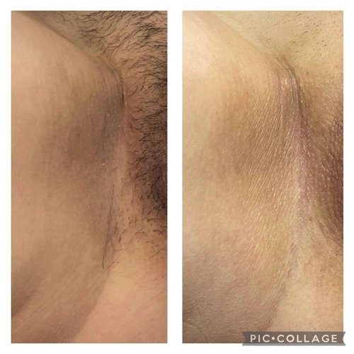 Underarm before and after brightening treatment